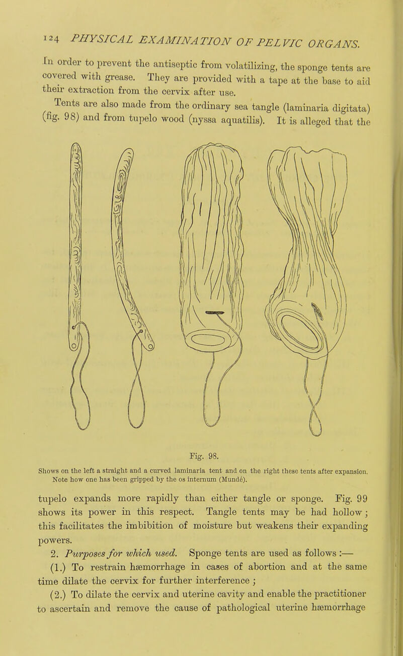 In order to prevent the antiseptic from volatilizing, the sponge tents are covered with grease. They are provided with a tape at the base to aid their extraction from the cervix after use. Tents are also made from the ordinary sea tangle (laminaria digitate) (fig. 98) and from tupelo wood (nyssa aquatilis). It is alleged that the \3 Fig. 98. Shows on the left a straight and a curved laminaria tent and on the right these tents after expansion. Note how one has been gripped by the os internum (Munde). tupelo expands more rapidly than either tangle or sponge. Fig. 99 shows its power in this respect. Tangle tents may be had hollow; this facilitates the imbibition of moisture but weakens their expanding powers. 2. Purposes for which used. Sponge tents are used as follows :— (1.) To restrain haemorrhage in cases of abortion and at the same time dilate the cervix for further interference ; (2.) To dilate the cervix and utei-ine cavity and enable the practitioner to ascertain and remove the cause of pathological uterine haemorrhage