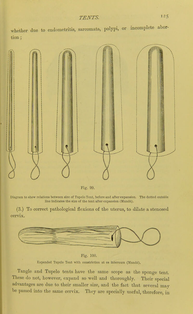 whether due to endometritis, sarcomata, polypi, or incomplete abor- tion ; Pig. 99. Diagram to show relations between size of Tupelo Tent, before and after expansion. The dotted outside line indicates the size of the tent after expansion (Munde). (3.) To correct pathological flexions of the uterus, to dilate a stenosed cervix. Fig. 100. Expanded Tupelo Tent with constriction at os internum (Munde). Tangle and Tupelo tents have the same scope as the sponge tent. These do not, however, expand so well and thoroughly. Their special advantages are clue to their smaller size, and the fact that several mav be passed into the same cervix. They are specially useful, therefore, in