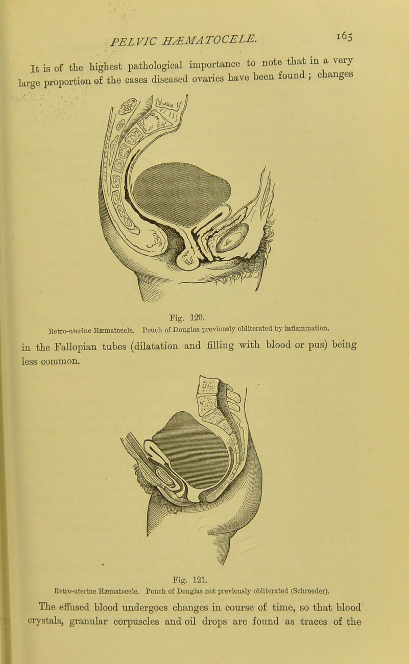 Fig. 120. Retro-uterine Hematocele. Pouch of Douglas previously obliterated by inflammation. in the Fallopian tubes (dilatation and filling with blood or pus) being less common. Fig. 121. Retro-uterine Hsematocele. Pouch of Douglas not previously obliterated (Schroeder). The effused blood undergoes changes in course of time, so that blood crystals, granular corpuscles and oil drops are found as traces of the