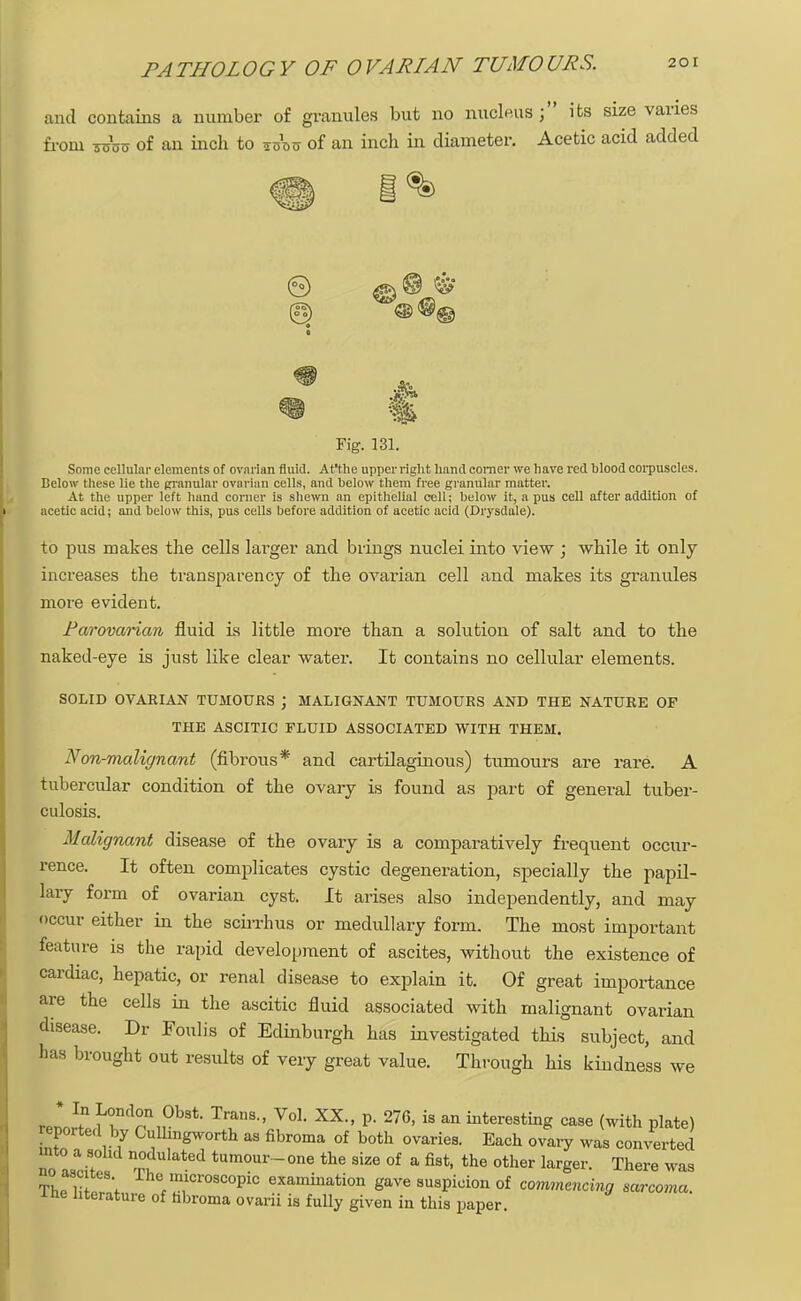 and contains a number of granules but no micleus; its size varies from toto of an inch to toou of an inch in diameter. Acetic acid added fa Fig. 131. Some cellular elements of ovarian fluid. At'the upperright hand comer we have red blood corpuscles. Below these lie the granular ovarian cells, and below them free granular matter. At the upper left hand corner is shewn an epithelial cell; below it, a pus cell after addition of acetic acid; and below this, pus cells before addition of acetic acid (Drysdale). to pus makes the cells larger and brings nuclei into view ; while it only- increases the transparency of the ovarian cell and makes its granules more evident. Parovarian fluid is little more than a solution of salt and to the naked-eye is just like clear water. It contains no cellular elements. SOLID OVARIAN TUMOURS ; MALIGNANT TUMOURS AND THE NATURE OF THE ASCITIC FLUID ASSOCIATED WITH THEM. Non-malignant (fibrous* and cartilaginous) tumours are rare. A tubercular condition of the ovary is found as part of general tuber- culosis. Malignant disease of the ovary is a comparatively frequent occur- rence. It often complicates cystic degeneration, specially the papil- lary form of ovarian cyst. It arises also independently, and may occur either in the scirrhus or medullary form. The most important feature is the rapid development of ascites, without the existence of cardiac, hepatic, or renal disease to explain it. Of great importance are the cells in the ascitic fluid associated with malignant ovarian disease. Dr Foulis of Edinburgh has investigated this subject, and has brought out results of very great value. Through his kindness we veUZ rn,r)b8t- TvnB V°L XX- P' 276' i8 an ^sting case (with plate) reported by Cullmgworth as fibroma of both ovaries. Each ovary was converted rTo ascitol1 ^Ulated tumour-one the size of a fist, the other larger. There was ThP li V ^ microscopic examination gave suspicion of commencing sarcoma. ine literature of fabroma ovarii is fully given in this paper.