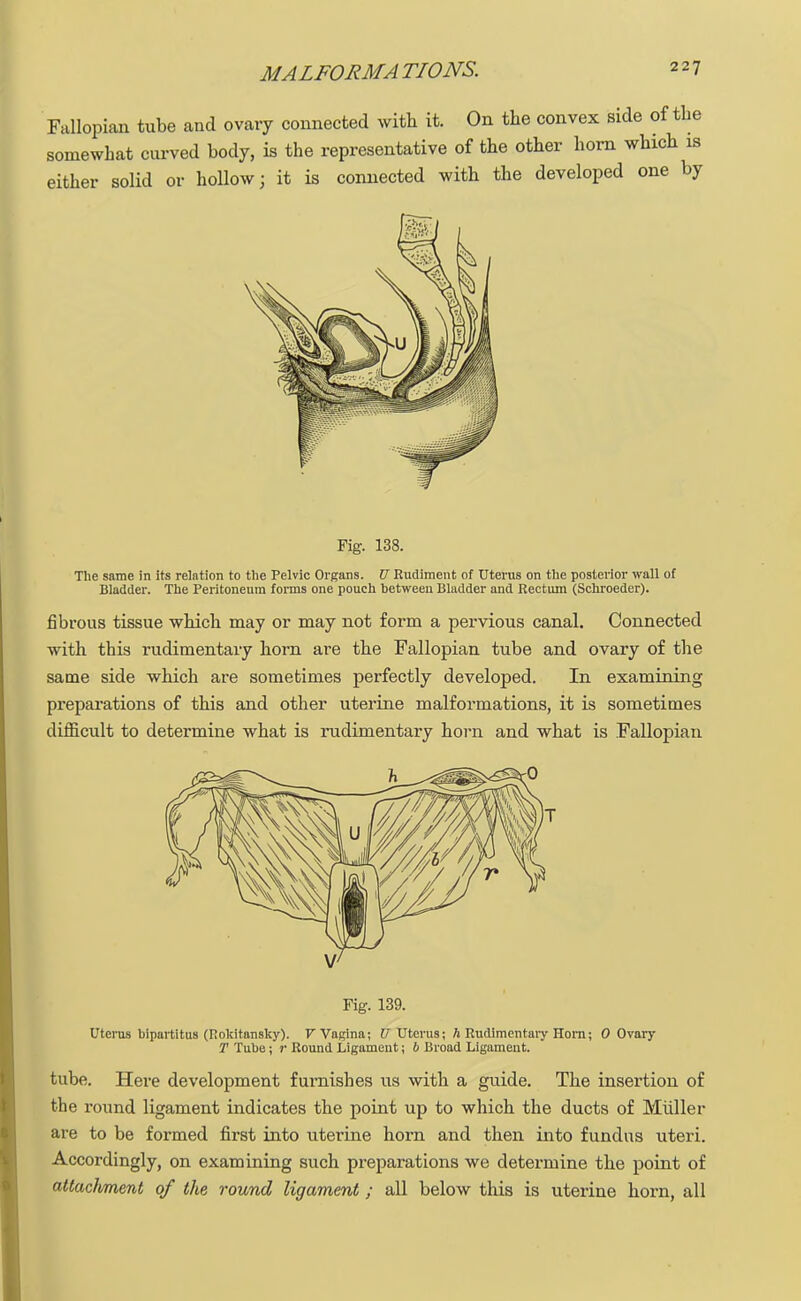 Fallopian tube and ovary connected with it. On the convex side of the somewhat curved body, is the representative of the other horn which is either solid or hollow; it is connected with the developed one by Fig. 138. The same in its relation to the Pelvic Organs. U Rudiment of Uterus on the posterior wall of Bladder. The Peritoneum forms one pouch between Bladder and Rectum (Schroeder). fibrous tissue which may or may not form a pervious canal. Connected with this rudimentary horn are the Fallopian tube and ovary of the same side which are sometimes perfectly developed. In examining preparations of this and other uterine malformations, it is sometimes difficult to determine what is rudimentary horn and what is Fallopian Fig. 139. Uterus bipartitus (Rolritansky). V Vagina; XJ Uterus; h Rudimentary Horn; 0 Ovary T Tube; r Round Ligament; b Broad Ligament. tube. Here development furnishes us with a guide. The insertion of the round ligament indicates the point up to which the ducts of Muller are to be formed first into uterine horn and then into fundus uteri. Accordingly, on examining such preparations we determine the point of attaclvment of the round ligament ; all below this is uterine horn, all