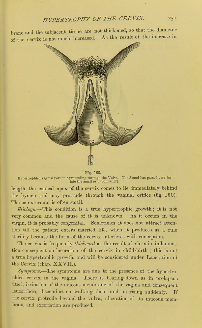 brane and the subjacent tissue are not thickened, so that the diameter of the cervix is not much increased. As the result of the increase in Fig. 160. Hypertrophled vaginal portion c protruding through the Vulva. The Sound has passed very far into the small os o (Schroeder). length, the conical apex of the cervix comes to lie immediately behind the hymen and may protrude through the vaginal orifice (fig. 160). The os externum is often small. Etiology.—This condition is a true hypertrophic growth; it is not very common and the cause of it is unknown. As it occurs in the virgin, it is probably congenital. Sometimes it does not attract atten- tion till the patient enters married life, when it produces as a rule sterility because the form of the cervix interferes with conception. The cervix is frequently thickened as the result of chronic inflamma- tion consequent on laceration of the cervix in child-birth ; this is not a true hypertrophic growth, and will be considered under Laceration of the Cervix (chap. XXVII.). Symptoms.—The symptoms are due to the presence of the hypertro- phied cervix in the vagina. There is bearing-down as in prolapsus uteri, irritation of the mucous membrane of the vagina and consequent leucorrhcea, discomfort on walking about and on rising suddenly. If the cervix protrude beyond the vulva, ulceration of its mucous mem- brane and excoriation are produced.