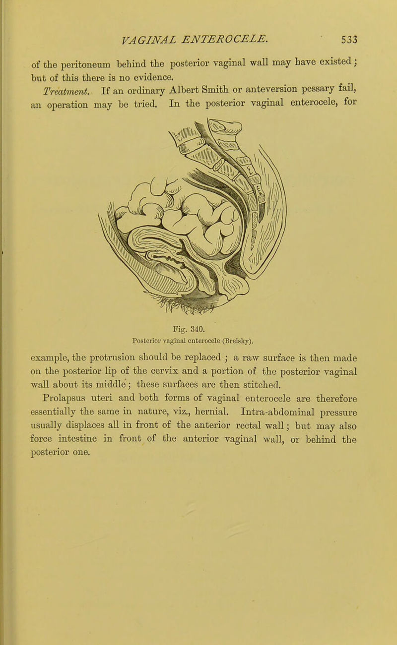 of the peritoneum behind the posterior vaginal wall may have existed ; but of this there is no evidence. Treatment. If an ordinary Albert Smith or anteversion pessary fail, an operation may be tried. In the posterior vaginal enterocele, for Fig. 340. Posterior vaginal enterocele (Breisky). example, the protrusion should be replaced ; a raw surface is then made on the posterior lip of the cervix and a portion of the posterior vaginal wall about its middle; these surfaces are then stitched. Prolapsus uteri and both forms of vaginal enterocele are therefore essentially the same in nature, viz., hernial. Intra-abdominal pressure usually displaces all in front of the anterior rectal wall; but may also force intestine in front of the anterior vaginal wall, or behind the posterior one.
