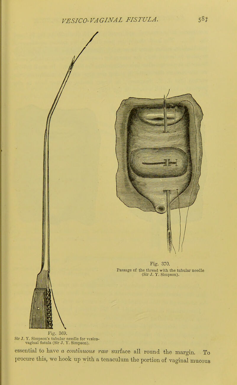 Fig. 369. Sir J. Y. Simpson's tubular needle for vesico- vaginal fistula (Sir J. Y. Simpson). essential to have a continuous raw surface all round the margin. To procure this, we hook up with a tenaculum the portion of vaginal mucous