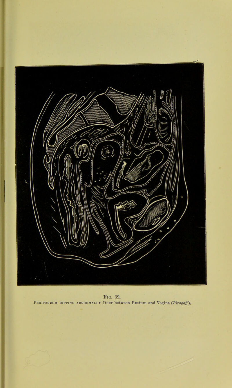 Fig. 39. Peritonbum dipping abnormally Deep between Rectum and Vagina (Pirogoff).