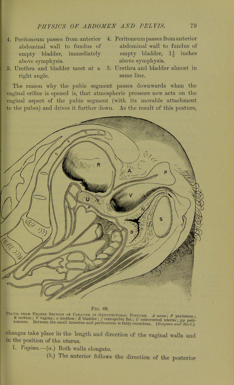 4. Peritoneum passes from anterior abdominal wall to fundus of empty bladder, immediately above symphysis. 5. Urethra and bladder meet at a right angle. 4. Peritoneum passes from anterior abdominal wall to fundus of empty bladder, \\ inches above symphysis. 5. Urethra and bladder almost in same line. The reason why the pubic segment passes downwards when the vaginal orifice is opened is, that atmospheric pressure now acts on the vaginal aspect of the pubic segment (with its movable attachment to the pubes) and drives it further down. As the result of this posture, Fig. 60. Pelvis from Frozen Section of Cadaver in- Genupectoral Posture. A anus: P perineum • f nnr« '■'^'^V  = ^ ^l^^''^^ : ^et^oP^bic fat; U retroverted uterus^JS peril toneum. Between the small intestine and peritoneum is fatty omentum. {Simpson ami //a, ( ) changes take place in the length and direction of the vaginal walls and in the position of the uterus. 1. Vagina.—{a.) Both walls elongate. {h.) The anterior follows the direction of the posterior