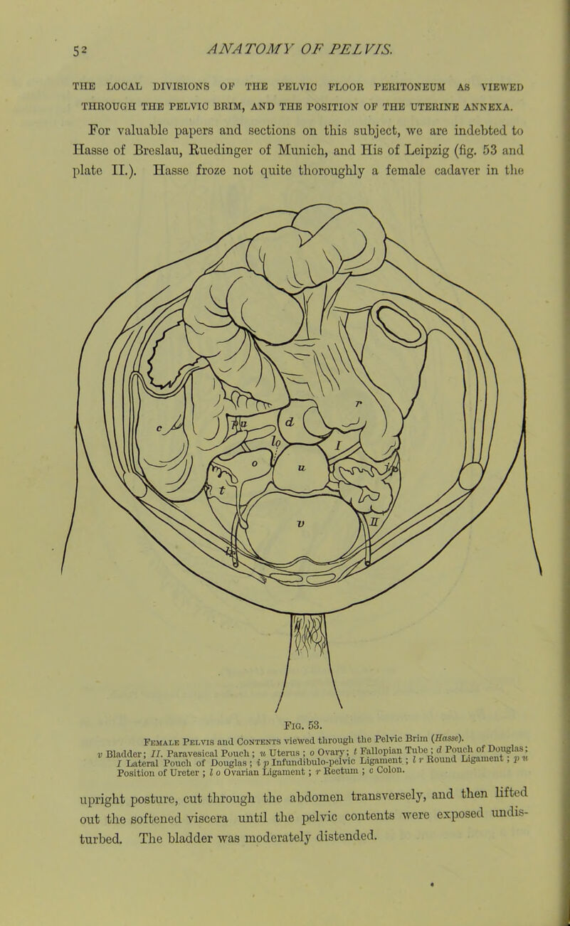 THE LOCAL DIVISIONS OF THE PELVIC FLOOR PERITONEUM AS VIEWED THROUGH THE PELVIC BRIM, AND THE POSITION OF THE UTERINE ANNEXA. For valuable papers and sections on this subject, we are indebted to Hasse of Breslau, Ruedinger of Munich, and Iiis of Leipzig (fig. 53 and plate II.). Hasse froze not quite thoroughly a female cadaver in the Fig. 53. Female Pelvis and Contents viewed through the Pelvic Brim (Ilasse). v Bladder; II. Paravesical Pouch ; u Uterus ; o Ovary; t Fallopian Tubed Poucli^of Dougias; I Lateral Pouch of Douglas ; i p Infundibulo-pelvic Ligament ; l r Round Ligament, p Position of Ureter ; l o Ovarian Ligament; r Rectum ; c Colon. upright posture, cut through the abdomen transversely, and then lifted out the softened viscera until the pelvic contents were exposed undis- turbed. The bladder was moderately distended.