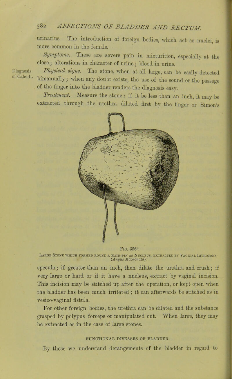 Diagnosis of Calculi. 582 AFFECTIONS OF BLADDER AND RECTUM. urinarius. The introduction of foreign bodies, which act as nuclei, is more common in tho female. Symptoms. These are severe pain in micturition, especially at the close; alterations in character of urine ; blood in urine. Physical signs. The stone, when at all large, can be easily detected bimanually, when any doubt exists, the use of the sound or the passage of the finger into the bladder renders the diagnosis easy. Treatment. Measure the stone : if it be less than an inch, it may be extracted through the urethra dilated first by the finger or Simon’s Fig. 356®. Large Stone which formed round a hair-pin as Nucleus, extracted by Vaginal Lithotomy (Angus Macdonald). specula; if greater than an inch, then dilate the urethra and crush; if very large or hard or if it have a nucleus, extract by vaginal incision. This incision may be stitched up after the operation, or kept open when the bladder has been much irritated; it can afterwards be stitched as in vesico-vaginal fistula. For other foreign bodies, the urethra can be dilated and the substance grasped by polypus forceps or manipulated out. When large, they may be extracted as in the case of large stones. FUNCTIONAL DISEASES OF BLADDER. By these we understand derangements of the bladder in regard to