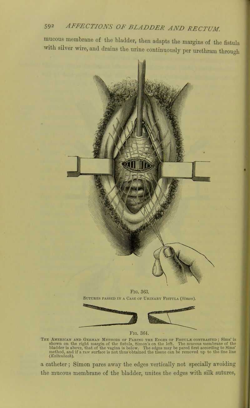 raucous membrane of the bladder, then adapts the margins of the fistula with silver wire, and drains the urine continuously per urethram through Fig. 363. Sutures passed in a Case of Urinary Fistula (Simon). The American and German Methods of Paring the Edges of Fistula contrasted ; Sims’ is shown on the right margin of the fistula, Simon’s on the left. The mucous membrane of the bladder is above, that of the vagina is below. The edges may be pared first according to Sims’ method, and if a raw surface is not thus obtained the tissue can be removed up to the fine line (Kaltenbach). a catheter; Simon pares away the edges vertically not specially avoiding the mucous membrane of the bladder, unites the edges with silk sutures,