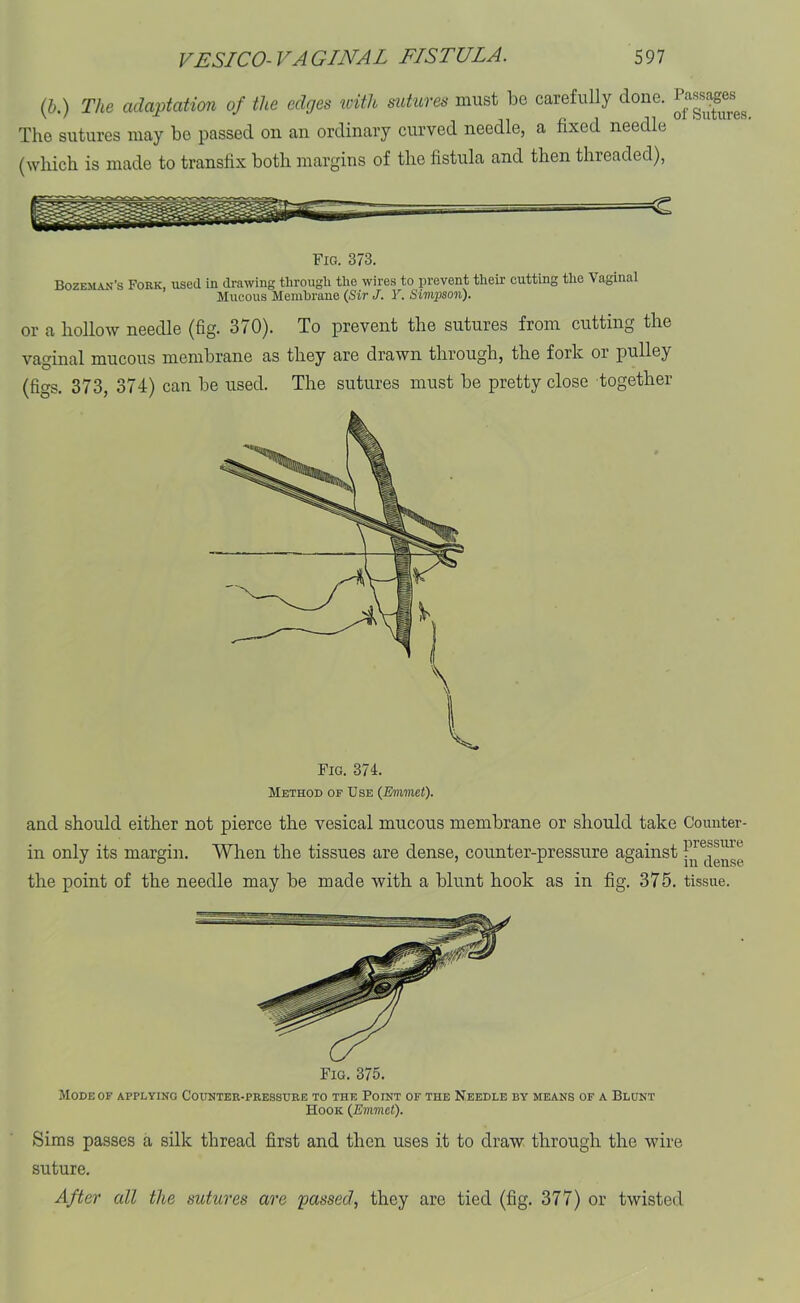 (b.) The adaptation of the edges with sutures must be carefully done. The sutures may be passed on an ordinary curved needle, a fixed needle (which is made to transfix both margins of the fistula and then threaded), Fig. 373. Bozeman’s Fork, used in drawing through the wires to prevent their cutting the Vaginal Mucous Membrane (Sir J. Y, Simpson). or a hollow needle (fig. 370). To prevent the sutures from cutting the vaginal mucous membrane as they are drawn through, the fork or pulley (figs. 373, 374) can be used. The sutures must be pretty close together and should either not pierce the vesical mucous membrane or should take Counter- in only its margin. When the tissues are dense, counter-pressure against the point of the needle may be made with a blunt hook as in fig. 375. tissue. Fig. 375. Mode or applying Counter-pressure to the Point of the Needle by means of a Blunt Hook (Emmet). Sims passes a silk thread first and then uses it to draw through the wire suture. After all the sutures are passed, they are tied (fig. 377) or twisted