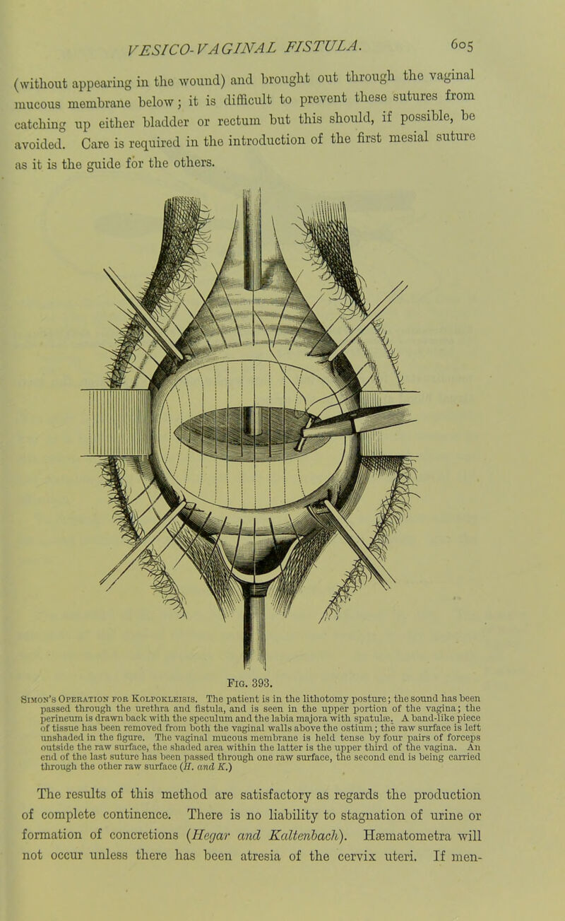 (without appearing in the wound) and brought out through the vaginal mucous membrane below; it is difficult to prevent these sutures from catching up either bladder or rectum but this should, if possible, be avoided. Caro is required in the introduction of the first mesial suture as it is the guide for the others. Fig. 393. Simon’s Operation for Kolpokleisis. The patient is in the lithotomy posture; the sound has been passed through the urethra and fistula, and is seen in the upper portion of the vagina; the perineum is drawn back with the speculum and the labia majora with spatulae. A band-like piece of tissue has been removed from both the vaginal walls above the ostium; the raw surface is left unshaded in the figure. The vaginal mucous membrane is held tense by four pairs of forceps outside the raw surface, the shaded area within the latter is the upper third of the vagina. An end of the last suture has been passed through one raw surface, the second end is being carried through the other raw surface (II. and K.) The results of this method are satisfactory as regards the production of complete continence. There is no liability to stagnation of urine or formation of concretions (Ilerjar and Kalteribacli). Hsematometra will not occur unless there has been atresia of the cervix uteri. If men-