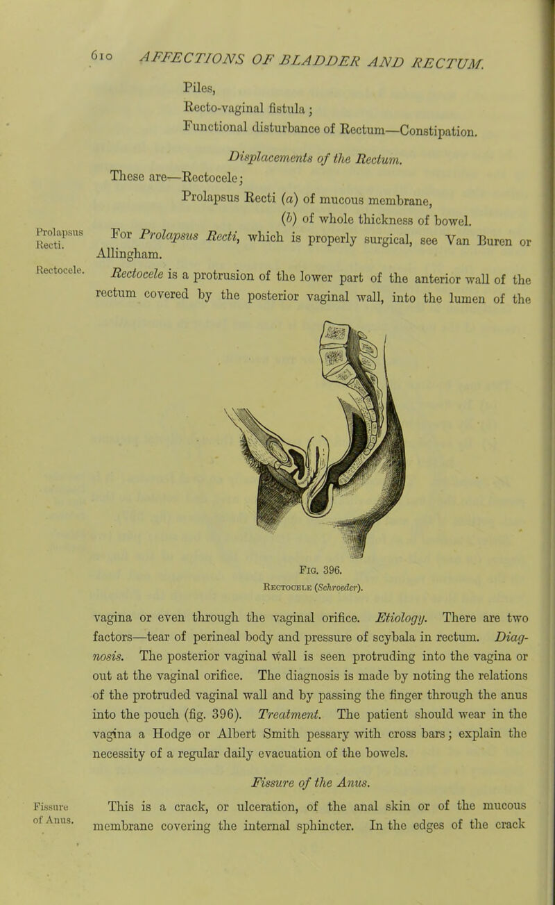 Prolapsus Recti. Rectocele. Fissure of Anus. 610 AFFECTIONS OF BLADDER AND RECTUM. Piles, Recto-vaginal fistula; 1 unctional disturbance of Rectum—Constipation. Displacements of the Rectum. These are—Rectocele; Prolapsus Recti (a) of mucous membrane, ip) of whole thickness of bowel. For Prolapsus Recti, which is properly surgical, see Van Buren or Allingham. Rectocele is a protrusion of the lower part of the anterior wall of the rectum covered by the posterior vaginal wall, into the lumen of the Fig. 396. Rectocele (Scliroedcr). vagina or even through the vaginal orifice. Etiology. There are two factors—tear of perineal body and pressure of scybala in rectum. Diag- nosis. The posterior vaginal wall is seen protruding into the vagina or out at the vaginal orifice. The diagnosis is made by noting the relations of the protruded vaginal wall and by passing the finger through the anus into the pouch (fig. 396). Treatment. The patient should wear in the vagina a Hodge or Albert Smith pessary with cross bars; explain the necessity of a regular daily evacuation of the bowels. Fissure of the Anus. This is a crack, or ulceration, of the anal skin or of the mucous membrane covering the internal sphincter. In the edges of the crack