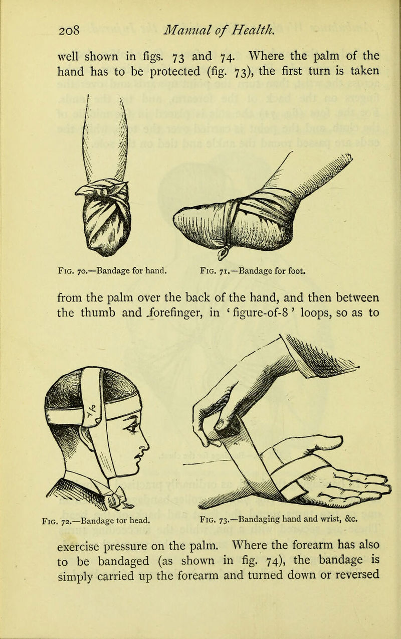 well shown in figs. 73 and 74. Where the palm of the hand has to be protected (fig. 73), the first turn is taken Fig. 70.—Bandage for hand. Fig. 71.—Bandage for foot. from the palm over the back of the hand, and then between the thmnb and Jorefinger, in ' figure-of-8 ' loops, so as to Fig. 72.—Bandage tor head. Fig. 73.—Bandaging hand and wrist, &c. exercise pressure on the palm. Where the forearm has also to be bandaged (as shown in fig. 74), the bandage is simply carried up the forearm and turned down or reversed