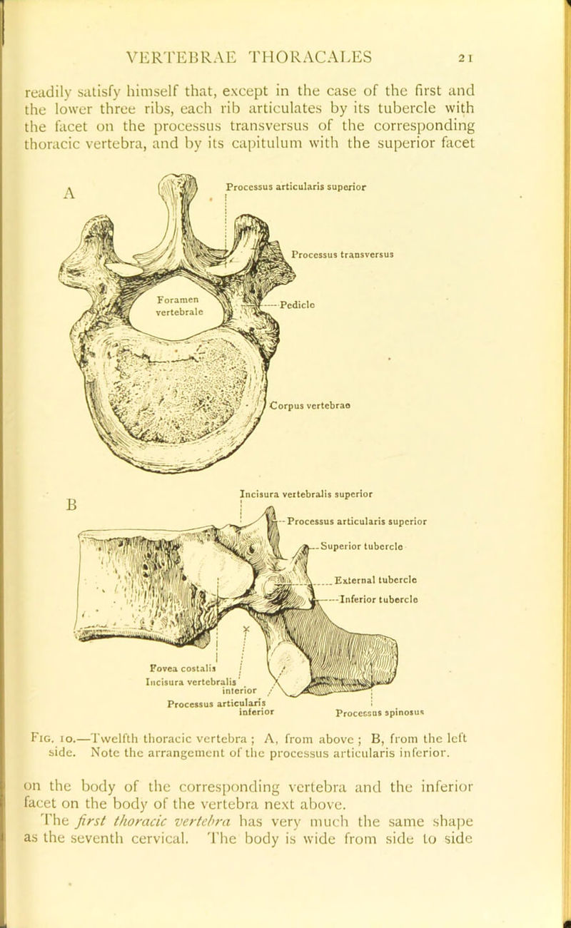 readily satisfy himself that, except in the case of the first and the lower three ribs, each rib articulates by its tubercle with the facet on the processus transversus of the corresponding thoracic vertebra, and by its capitulum with the superior facet Corpus vertebra© Processus transversus Processus articularis superior . r Incisura veitebralis superior Processus articularis superior Superior tubercle Eaternal tubercle Inferior tubercle Fovea costaiis / Incisura vertcbralis* , interior Processus articularis inferior Proccesns spinosus F'ig. io.—Twelfth thoracic vertebra ; A, from above ; B, from the left side. Note the arrangement of the processus articularis inferior. on the body of the corresponding vertebra and the inferior facet on the body of the vertebra next above. 'I'he first thoracic vertebra has very much the same shape as the seventh cervical. 'The body is wide from side to side