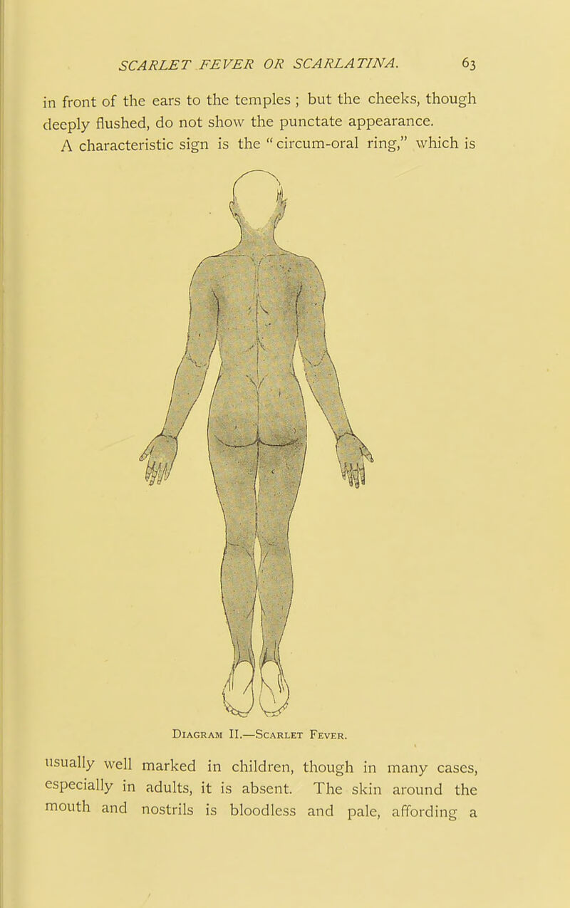 in front of the ears to the temples ; but the cheeks, though deeply flushed, do not show the punctate appearance. A characteristic sign is the  circum-oral ring, which is Diagram II.—Scarlet Fever. usually well marked in children, though in many cases, especially in adults, it is absent. The skin around the mouth and nostrils is bloodless and pale, affording a