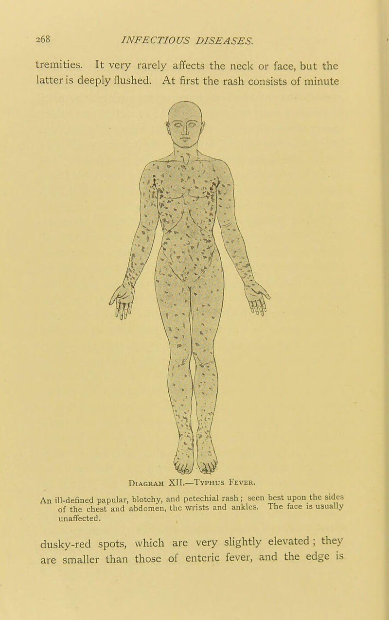 tremities. It very rarely affects the neck or face, but the latter is deeply flushed. At first the rash consists of minute Diagram XII.—Typhus Fever. An ill-defined papular, blotchy, and petechial rash; seen best upon the sides of the chest and abdomen, the wrists and ankles. The face is usually unaffected. dusky-red spots, which are very slightly elevated; they are smaller than those of enteric fever, and the edge is