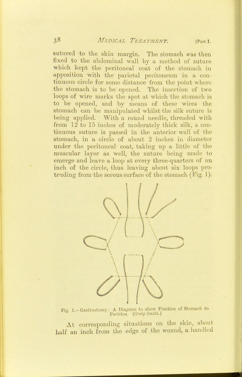 sutured to the skin margin. The stomach was then fixed to the abdominal wall by a method of suture which kept the peritoneal coat of the stomach in apposition with the parietal peritoneum in a con- tinuous circle for some distance I'rom the point where the stomach is to be opened. The insertion of two loops of wire marks the spot at which tlie stomach is to be opened, and by means of these wires the stomach can be manipulated whilst the silk suture is being applied. With a round needle, threaded with from 12 to 15 inches of moderately thick silk, a con- tinuous suture is passed in the anterior wall of the stomach, in a circle of about 2 inches in diameter under the peritoneal coat, taking uj) a little of the muscular layer as well, the suture being made to emerge and leave a loop at every three-quarters of an inch of the circle, thus leaving about six loops pro- truding from the serous surface of the stomach (Fig. 1). Fi'T 1 -Gastrostomy: A Diagram to show Fixation of Stoinacli to  Parietus. (finig Smith.) At corresponding situations on the skin, about half an inch from the edge of the wound, a handled