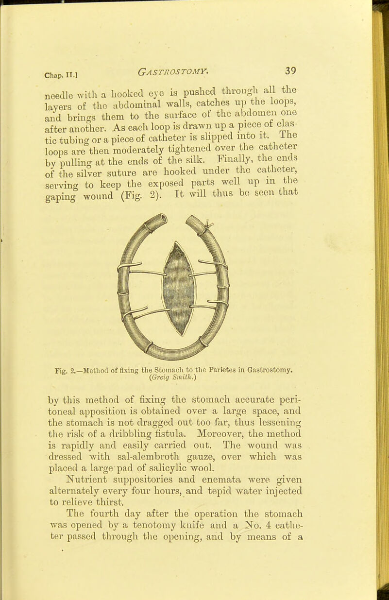 Chap, n.l needle with a hooked eye is pushed through all the layers of the abdominal walls, catches up the loops, and brings them to the surface of the abdomen one after another. As each loop is drawn up a piece ot eias tic tubing or a piece of catheter is slipped into it ihe loops are then moderately tightened over the catheter by pulling at the ends of the silk. Finally, the ends of the silver suture are hooked under the catheter, serving to keep the exposed parts well up in the gaping wound (Fig. 2). It will thus b(>, seen that Fig. 2.—Method of fixing the Stoinacli to the Parietes in Gastrostomy. {Greig Smith.) by this method of fixing the stomach accurate peri- toneal apposition is obtained over a large space, and the stomach is not dragged out too far, thus lessening the risk of a dribbling fistula. Moreover, the method is rapidly and easily carried out. The wound was dressed with sal-alembroth gauze, over which was placed a large pad of salicylic wool. Nutrient suppositories and enemata were given alternately every four hours, and tepid Avater injected to relieve thirst. The fourth day after the operation the stomach was opened by a tenotomy knife and a No. 4 cathe- ter passed through tlie opening, and by means of a