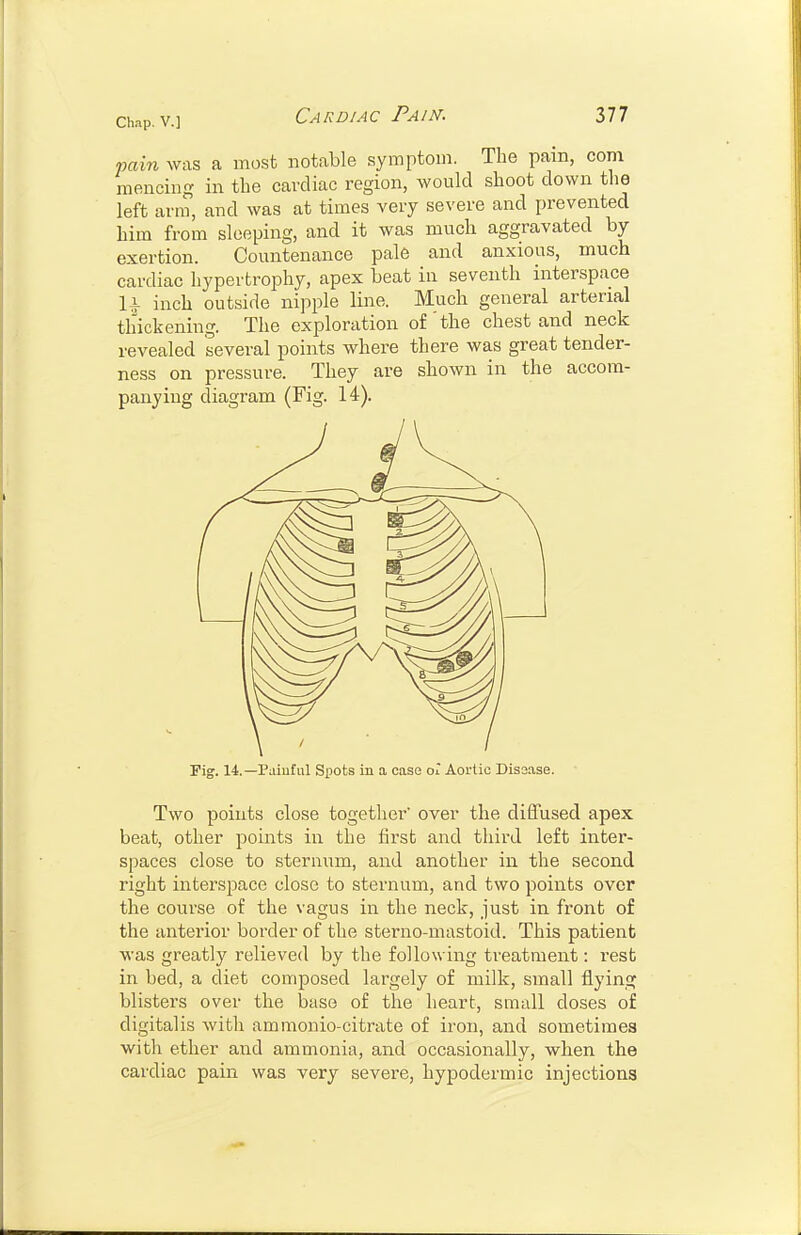 pain was a most notable symptom. The pain, com mencing in the cardiac region, would shoot down the left arm, and was at times very severe and prevented him from sleeping, and it was much aggravated by exertion. Countenance pale and anxious, much cardiac hypertrophy, apex beat in seventh interspace U inch outside nipple line. Much general arterial thickening. The exploration of'the chest and neck revealed several points where there was great tender- ness on pressure. They are shown in the accom- panying diagram (Fig. 14). !Fig. 14.—Painful Spots in a case ol Aortic Disease. Two points close together' over the diffused apex beat, other points in the first and third left inter- spaces close to sternum, and another in the second right interspace close to sternum, and two points over the course of the vagus in the neck, just in front of the anterior border of the sterno-mastoid. This patient was greatly relieved by the following treatment: rest in bed, a diet composed largely of milk, small flying blisters over the base of the heart, small doses of digitalis with ammonio-citrate of iron, and sometimes with ether and ammonia, and occasionally, when the cardiac pain was very severe, hypodermic injections