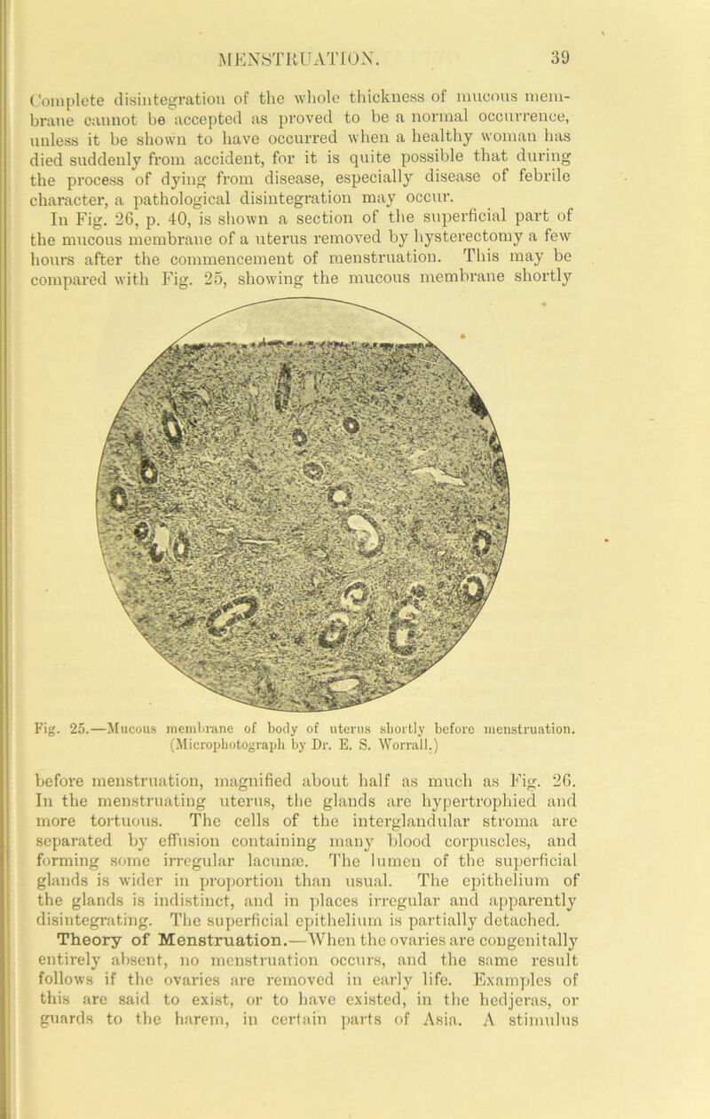 Coiuplete disintegration of the wliole thickness of inncons nieni- brane cannot he accepted as proved to be a normal occurrence, ! unless it be shown to have occurred when a healthy woman has died suddenly from accident, for it is quite possible that during the process of dying from disease, especially disease of febrile character, a pathological disintegration may occur. In Fig. 26, p. 40, is shown a section of the superficial part of the mucous membrane of a uterus removed by hysterectomy a few hours after the commencement of menstruation. This may be compared with Fig. 25, showing the mucous membi’ane shortly Fig. 25.—^[ucous memlirane of body of uterus sliortly before menstruation. (Micropbotograijli by Dr. E. S. Worrall.) before menstruation, magnified about half as much as Fig. 26. In the menstruating uterus, the glands are hypertrophied and more tortuous. The cells of the interglandular stroma are separated by effusion containing many blood corpuscles, and forming some irregular lacnnm. The lumen of the superficial glands is wider in projjortion than usual. The epithelium of the glands is indistinct, and in places irregular and apparently disintegrating. The superficial epithelium is partially detached. Theory of Menstruation.—When the ovaries are congenitally entirely absent, no menstruation occurs, and the same result follows if the ovaries are removed in early life. Exam])les of this are said to exist, or to have existed, in the hedjeras, or guards to the harem, in certain parts of Asia. A stimnlns