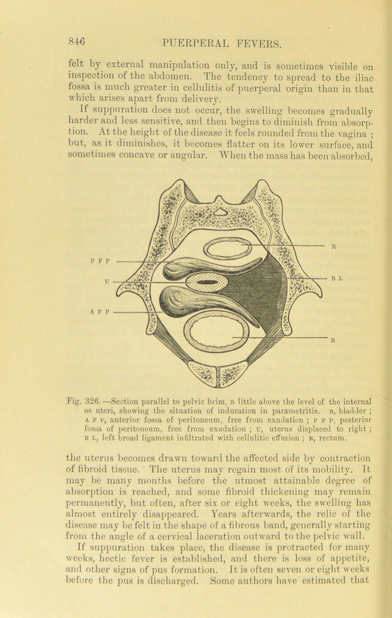 felt by external manipulation only, and is sometimes visible on inspection of the abdomen. The tendency to sjjread to the iliac fossa is much greater in cellulitis of puerperal origin than in that which arises apart from delivery. If suppuration does not occur, the swelling becomes gradually harder and less sensitive, and then begins to diminish from absorp- tion. At the height of tlie disease it feels rounded from the vagina ; but, as it diminishes, it becomes flatter on its lower surface, and sometimes concave or angidar. When the mass has been absorbed. Fig. .326.—Section parallel to pelvic brim, a little above the level of the internal os uteri, showing the situation of induration in parametritis, n, bladder ; A K anterior fos.sa of peritoneum, free from exudation ; r r r, posterior fos.sa of peritoneum, fiee from exudation ; u, uterus di.splaced to right ; I) h, left broad ligament iiililtratcd with cellulitic elTusion ; r, rectum. the uterus becomes drawn toward the affected side by contraction of fibroid tissue. 'I’he uterus may regain most of its mobility. It may be many moiitlis before the utmost attainable degree of absorption is reached, and some fibroid thickening may remain permanently, but often, after six or eight weeks, the swelling has almost entirely disappeared. Years afterwards, the relic of the disease may be felt in the shape of a fibrous band, generally starting from the angle of a cervical laceration outward to the pelvic wall. If suppuration takes place, the disease is protracted for many weeks, hectic fever is established, and there is loss of ajipetite, and other signs of pus foi-mation. It is often seven or eight weeks before the jdus is discharged. Some authors have estimated that