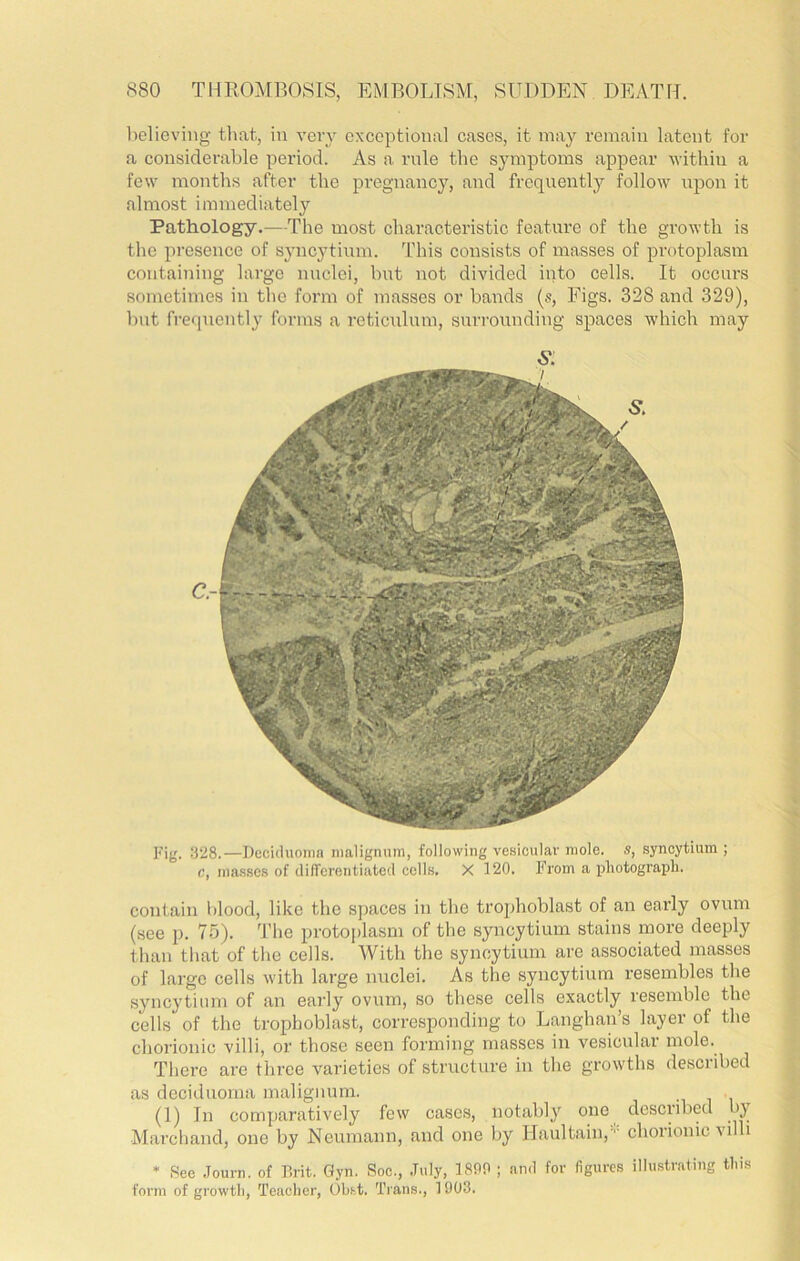 l)elieving tliat, in veiy cxcoptional cases, it may remain latent for a considerable period. As a rule the symptoms appear within a few months after the pregnancy, and frequently follow iipon it almost immediately Pathology.—The most characteristic feature of the growth is the presence of syncytium. 'Phis consists of masses of protoplasm containing large nuclei, but not di\nded into cells. It occurs sometimes in the foi’in of masses or bands [s, Figs. 328 and 329), but frequently forms a reticulum, surrounding spaces which may 6*: Cr Fig. 328.—Deciduoiiia nialignum, following vesicular mole, s, syncytium ; c, masses of difTerentiatecl cells. X 120. From a photograph. contain l)lood, like the spaces in the trophoblast of an early ovum (see p. 75). The protoplasm of the syncytium stains more deeply than that of the cells. AVith the syncytium are associated masses of large cells with large nuclei. As the syncytium resembles the syncytium of an early ovum, so these cells exactly resemble the cells of the trophoblast, corresponding to Langhan s layer of the chorionic villi, or those seen forming masses in vesicular mole. There are three varieties of structure in the growths described as deciduoma malignnm. (1) In comparatively few cases, notably one described by Marchand, one by Neumann, and one by Ilaultain,- chorionic villi * See Journ. of P.rit. Gyn. Soc., July, 18P9 ; and for figures illustrating this form of growth, Teacher, Obi-.t. Trans., 1903.