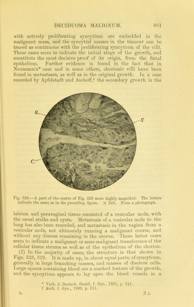 with actively proliferating syncytium are embedded in the malignant mass, and the syncytial masses in the tumour can be traced as continuous with the prolifei’ating syncytium of the villi. These cases seem to indicate the initial stage of the growth, and constitute the most decisive proof of its origin, from the foetal epithelium. Further evidence is found in the fact that in Neumann’s* case and in some others, chorionic villi have been found in metastases, as well as in the original growth. In a case recorded by Apfelstadt and Aschoff,t the secondary growth in the Fig. 329.—A part of the centre of Fig. 328 more highly magnified. The letters indicate the same as in the preceding figure. X 240. From a photograph. labium and paravaginal tissue consisted of a vesicular mole, with the usual stalks and cysts. Metastasis of a vesicular mole to the lung has also been recorded, and metastasis in the vagina from a vesicular mole, not ultimately running a malignant cour.se, and without any disease remaining in the uterus. These latter cases seem to indicate a malignant or semi-malignant transference of the cellular tissue stroma as well as of the epithelium of the chorion. (2) In the majority of cases, the structure is that shown in Figs. 328, 329. It is made up, in about equal parts, of syncytium, generally in large branching masses, and masses of discrete cells. Large spaces eontaining blood are a marked feature of the growth, and the syncytium appears to lay open tlie blood vessels in a * Verb. d. Dcutsch. Qesell. f. Gyn., 1891, p. 311. t Arch. f. (lyii., 1896, p. 511. 3 b o.