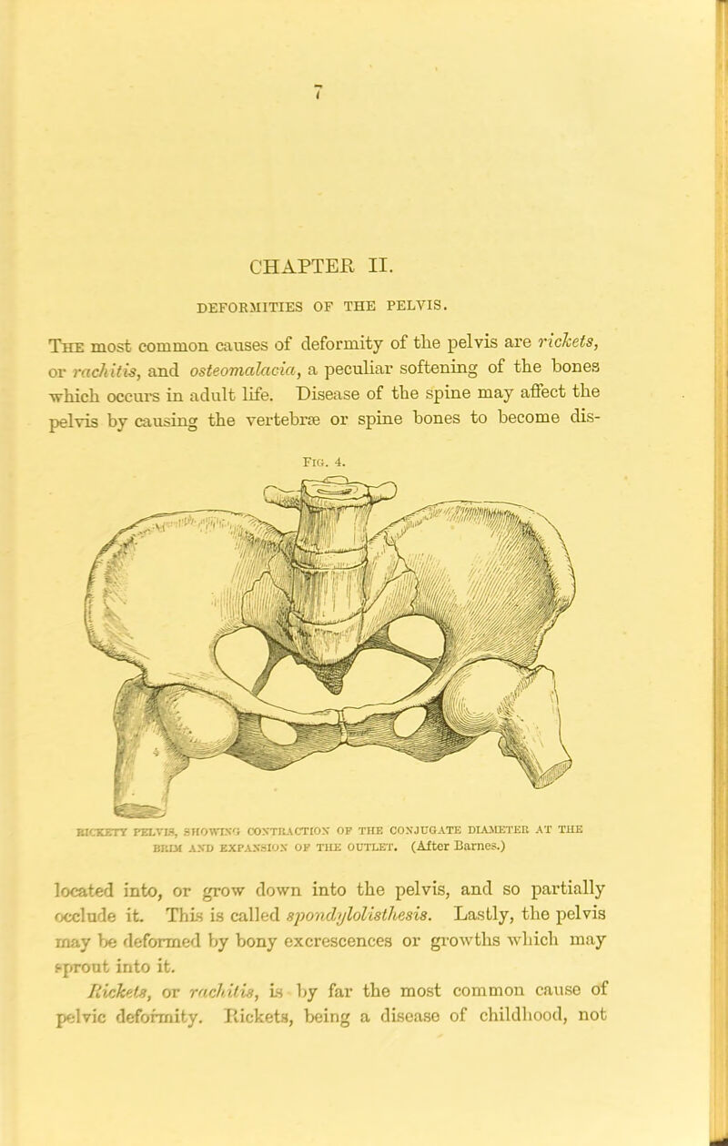 / CHAPTER II. DEFORMITIES OF THE PELVIS. The most common causes of deformity of tlie pelvis are rickets, or rachitis, and osteomalacia, a peculiar softening of the bones which occurs in adult life. Disease of the spine may affect the pelvis by causing the vertebrae or spine bones to become dis- FlCi. 4. RICKETY PELVIS, SHOWING CONTRACTION OP THE CONJUGATE DIAMETER AT THE brim and expansion op tue outlet. (After Barnes.) located into, or grow down into the pelvis, and so partially occlude it. This is called spondylolisthesis. Lastly, the pelvis may be deformed by bony excrescences or growths which may sprout into it. Rickets, or rachitis, is by far the most common cause of pelvic deformity. Rickets, being a disease of childhood, not