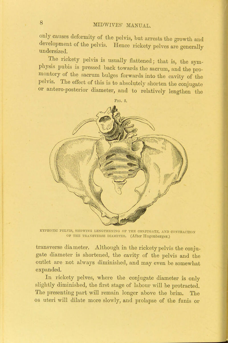 only causes deformity of the pelvis, but arrests the growth and development of the pelvis. Hence rickety pelves are generally undersized. The rickety pelvis is usually flattened; that is, the sym- physis pubis is pressed back towards the sacrum, and the pro- montory of the sacrum bulges forwards into the cavity of the pelvis. The effect of this is to absolutely shorten the conjugate or antero-posterior diameter, and to relatively lengthen the Fig. 5. KYPHOTIC PELVIS, SHOWING LENGTHENING OP THE CONJUGATE, AND CONTRACTION op the transverse diameter. (After Hugenberger.) transverse diameter. Although in the rickety pelvis the conju- gate diameter is shortened, the cavity of the pelvis and the outlet are not always diminished, and may even be somewhat expanded. In rickety pelves, where the conjugate diameter is only slightly diminished, the first stage of labour will be protracted. The presenting part will remain longer above the brim. The os uteri will dilate more slowly, and prolapse of the funis or