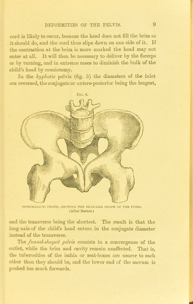 cord is likely to occur, because the head does not fill the brim as it should do, and the cord thus slips down on one side of it. If the contraction at the brim is more marked the head may not enter at all. It will then be necessary to deliver by the forceps or by turning, and in extreme cases to diminish the bulk of the child’s head by craniotomy. In the kyphotic pelvis (fig. 5) the diameters of the inlet are reversed, the conjugate or antero-posterior being the longest, Pig. 6. OSTEOMALACIC PELVIS, SHOWING THE BEAK-LIKE SHAPE OF THE PUBES. (After Barnes.) and the transverse being the shortest. The result is that the long axis of the child’s head enters in the conjugate diameter instead of the transverse. The funnel-shaped pelvis consists in a convergence of the outlet, while the brim and cavity remain unaffected. That is, the tuberosities of the ischia or seat-bones are nearer to each other than they should be, and the lower end of the sacrum is pushed too much forwards.