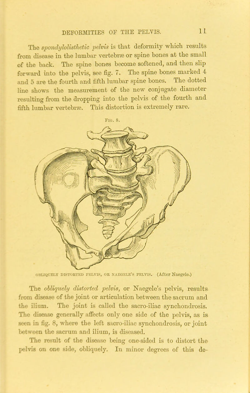 OBLIQUELY DISTORTED PELVIS, OR NAEGELB’S PELVIS. (After NaCgelo.) The obliquely distorted pelvis, or ISTaegele’s pelvis, results from disease of the joint or articulation between the sacrum and the ilium. The joint is called the sacro-iliac synchondrosis. The disease generally affects only one side of the pelvis, as is seen in fig. 8, where the left sacro-iliac synchondrosis, or joint between the sacrum and ilium, is diseased. The result of the disease being one-sided is to distort the pelvis on one side, obliquely. In minor degrees of this do- The spondylolisthetic pelvis is that deformity which results from disease in the lumbar vertebrae or spine bones at the small of the back. The spine bones become softened, and then slip forward into the pelvis, see fig. 7. The spine bones marked 4 and 5 are the fourth and fifth lumbar spine bones. The dotted line shows the measurement of the new conjugate diameter resulting from the dropping into the pelvis of the fourth and fifth lumbar vertebra. This distortion is extremely rare. Fig. S.