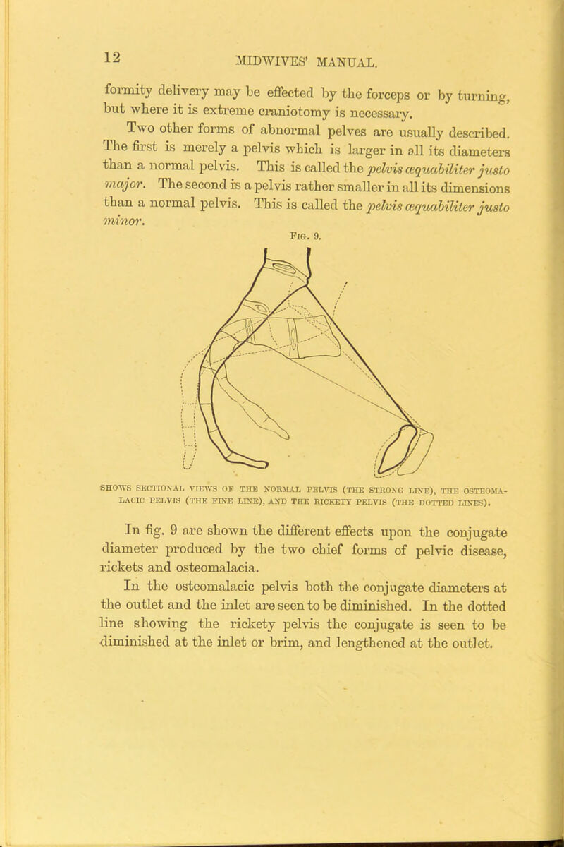 formity delivery may be effected by the forceps or by turning, but where it is extreme craniotomy is necessary. Two other forms of abnormal pelves are usually described. The first is merely a pelvis which is larger in all its diameters than a normal pelvis. This is called the pelvis cequabiliter justo major. The second is a pelvis rather smaller in all its dimensions than a normal pelvis. This is called the pelvis cequabiliter justo minor. Pig. 9. SHOWS SECTIONAL VIEWS OP THE NORMAL PELVIS (THE STRONG LINE), THE OSTEOMA- LACIC PELVIS (THE FINE LINE), AND THE RICKETY PELVIS (THE DOTTED LINES). In fig. 9 are shown the different effects upon the conjugate diameter produced by the two chief forms of pelvic disease, rickets and osteomalacia. In the osteomalacic pelvis both the conjugate diameters at the outlet and the inlet are seen to be diminished. In the dotted line showing the rickety pelvis the conjugate is seen to be diminished at the inlet or brim, and lengthened at the outlet.