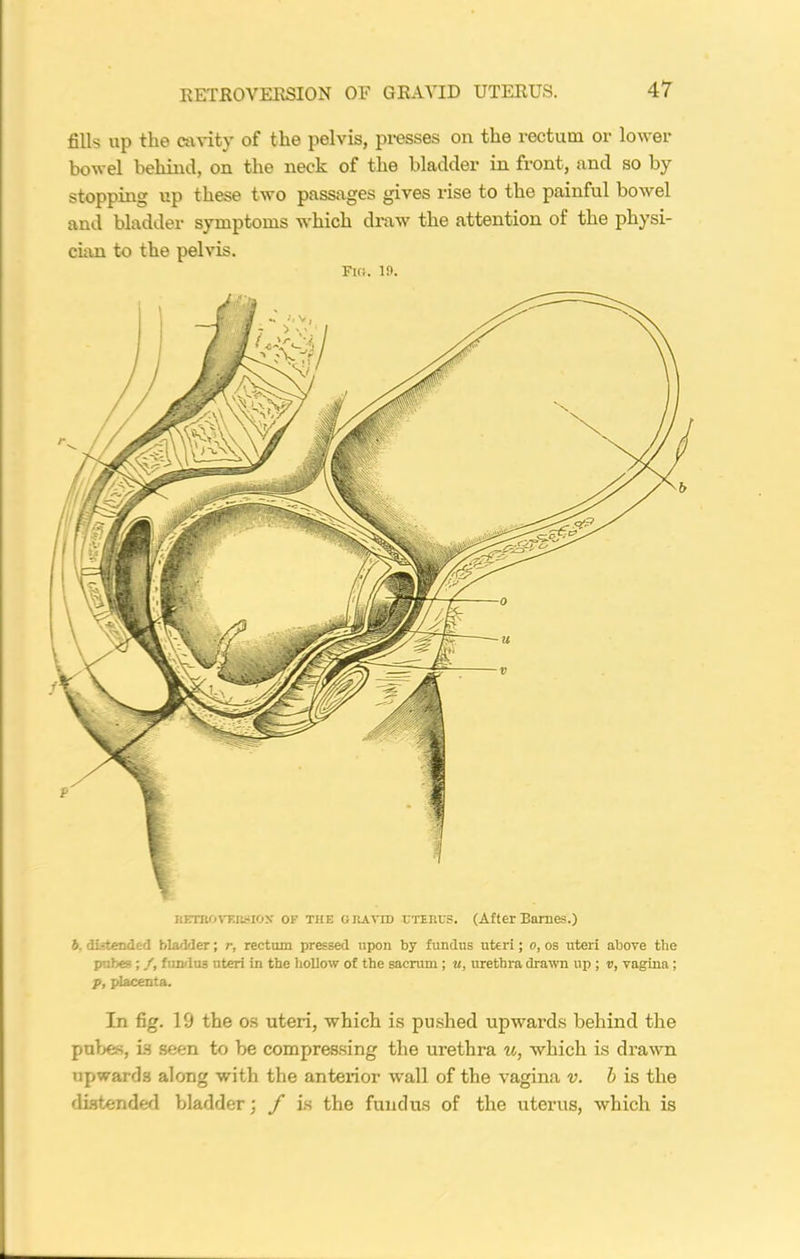 fills up the cavity of the pelvis, presses on the rectum or lower bowel behind, on the neck of the bladder in front, and so by stopping up these two passages gives rise to the painful bowel and bladder symptoms which draw the attention of the physi- cian to the pelvis. Fig. 19. b. distended bladder; r, rectum pressed upon by fundus uteri; o, os uteri above the pubes ; /, fundus uteri in the hollow of the sacrum; u, urethra drawn up ; v, vagina ; p, placenta. In fig. 19 the os uteri, which is pushed upwards behind the pubes, is seen to be compressing the urethra u, which is drawn upwards along with the anterior wall of the vagina v. b is the distended bladder; f is the fundus of the uterus, which is