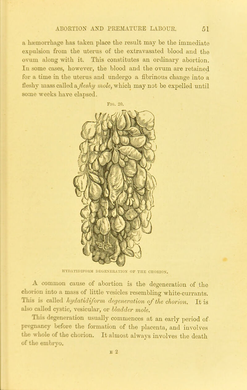 a haemorrhage has taken place the result may be the immediate expulsion from the uterus of the extravasatecl blood and the ovum along with it. This constitutes an ordinary abortion. In some cases, however, the blood and the ovum are retained for a time in the uterus and undergo a fibrinous change into a fleshy mass called a fleshy mole, which may not be expelled until some weeks have elapsed. Fi(i. 20. HYDATLDIFORM DEGENERATION OP THE CHORION. A common cause of abortion is the degeneration of the chorion into a mass of little vesicles resembling white-currants. This is called hydatidiform degeneration of the chorion. It is also called cystic, vesicular, or bladder mole. This degeneration usually commences at an early period of pregnancy before the formation of the placenta, and involves the whole of the chorion. It almost always involves the death of the embryo.