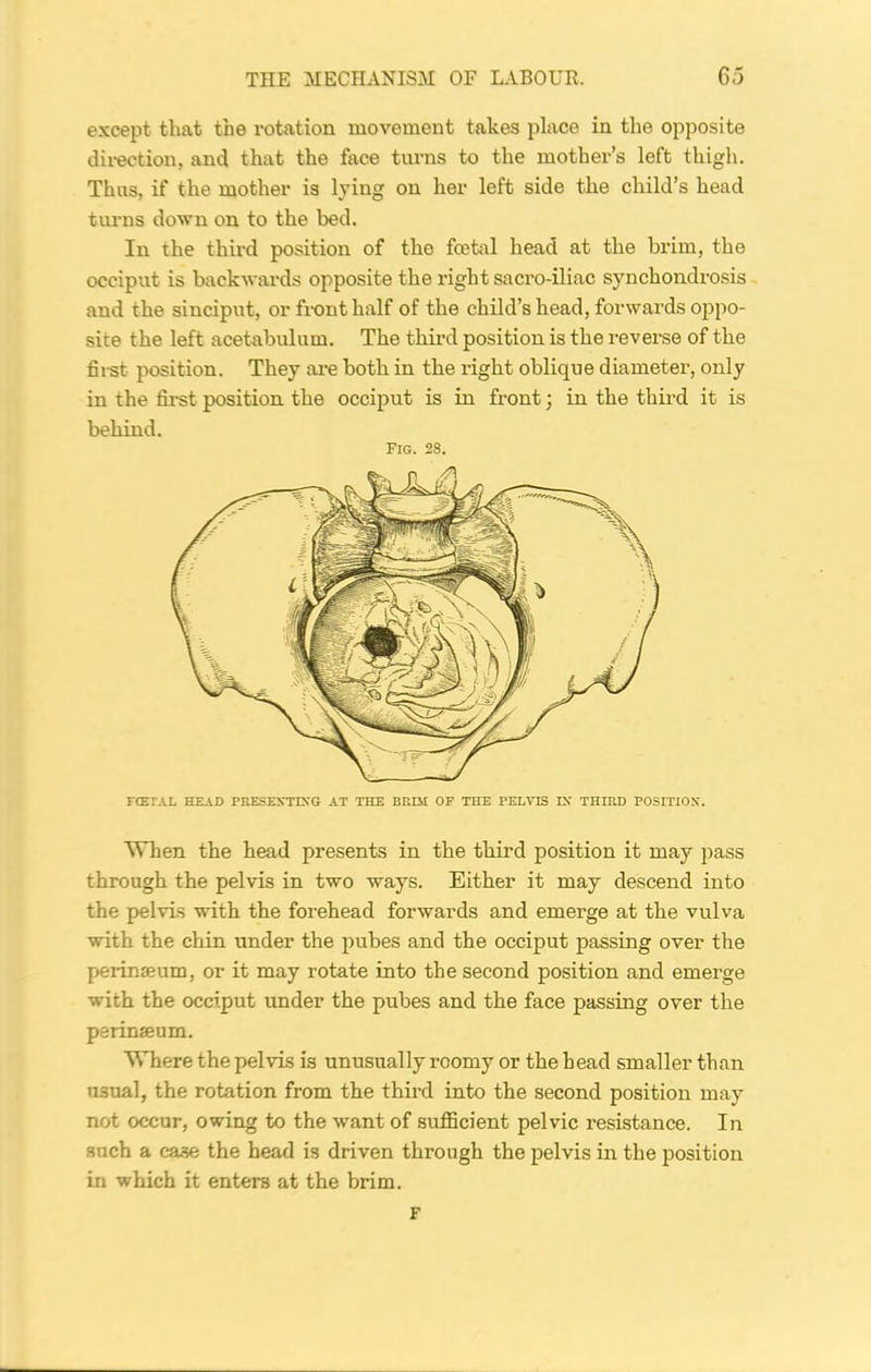 except that the rotation movement takes place in the opposite direction, and that the face turns to the mother’s left thigh. Thus, if the mother is lying on her left side the child’s head turns down on to the bed. In the third position of the fcetal head at the brim, the occiput is backwards opposite the right sacro-iliac synchondrosis and the sinciput, or front half of the child’s head, forwards oppo- site the left acetabulum. The third position is the reverse of the first position. They are both in the right oblique diameter, only in the first position the occiput is in front; in the third it is behind. Fig. 28. When the head presents in the third position it may pass through the pelvis in two ways. Either it may descend into the pelvis with the forehead forwards and emerge at the vulva with the chin under the pubes and the occiput passing over the perinseum, or it may rotate into the second position and emerge with the occiput under the pubes and the face passing over the perinseum. Where the pelvis is unusually roomy or the head smaller than usual, the rotation from the third into the second position may not occur, owing to the want of sufficient pelvic resistance. In such a case the head is driven through the pelvis in the position in which it enters at the brim. F