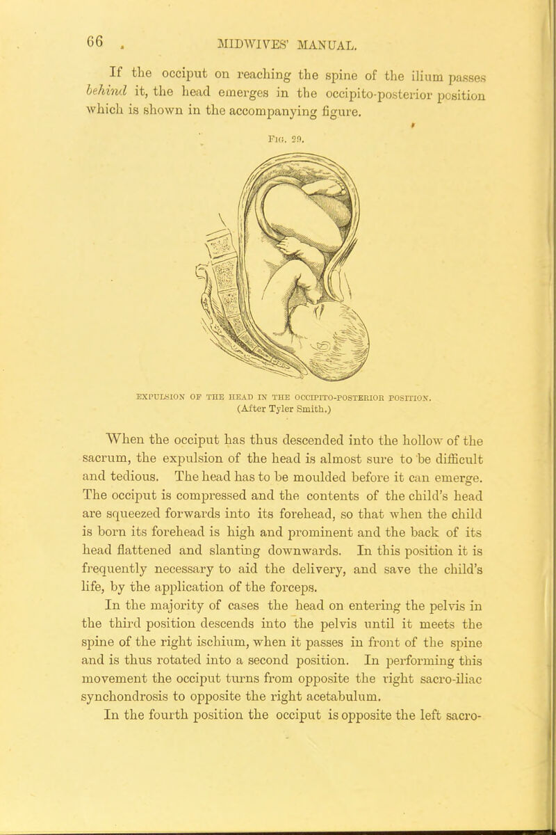 If the occiput on reaching the spine of the ilium passes behind it, the head emerges in the occipito-posterior position which is shown in the accompanying figure. f Fi«. 2!>. EXPULSION OP THE HEAD IN THE OCCIPITO-POSTERIOR POSITION. (After Tyler Smith.) When the occiput has thus descended into the hollow of the sacrum, the expulsion of the head is almost sure to be difficult and tedious. The head has to be moulded before it can emerge. The occiput is compressed and the contents of the child’s head are squeezed forwards into its forehead, so that when the child is born its forehead is high and prominent and the back of its head flattened and slanting downwards. In this position it is frequently necessary to aid the delivery, and save the child’s life, by the application of the forceps. In the majority of cases the head on entering the pelvis in the third position descends into the pelvis until it meets the spine of the right ischium, when it passes in front of the spine and is thus rotated into a second position. In performing this movement the occiput turns from opposite the right sacro-iliac synchondrosis to opposite the right acetabulum. In the fourth position the occiput is opposite the left sacro-