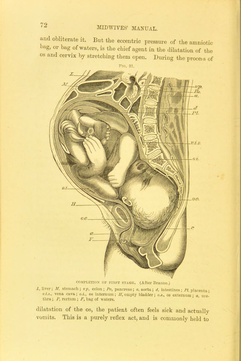 and obliterate it. But the eccentric pressure of the amniotic ’ng, or bag of waters, is the chief agent in the dilatation of the os and cervix by stretching them open. During the process of Fin. 81. dilatation of the os, the patient often feels sick and actually vomits. This is a purely reflex act, and is commonly held to