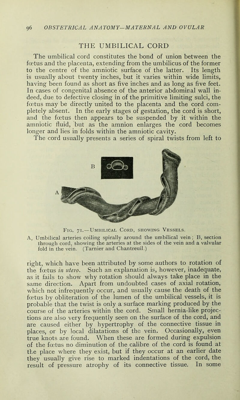 THE UMBILICAL CORD The umbilical cord constitutes the bond of union between the foetus and the placenta, extending from the umbilicus of the former to the centre of the amniotic surface of the latter. Its length is usually about twenty inches, but it varies within wide limits, having been found as short as five inches and as long as five feet. In cases of congenital absence of the anterior abdominal wall in- deed, due to defective closing in of the primitive limiting sulci, the foetus may be directly united to the placenta and the cord com- pletely absent. In the early stages of gestation, the cord is short, and the fcetus then appears to be suspended by it within the amniotic fluid, but as the amnion enlarges the cord becomes longer and lies in folds within the amniotic cavity. The cord usually presents a series of spiral twists from left to Fig. 71.—Umbilical Cord, showing Vessels. A, Umbilical arteries coiling spirally around the umbilical vein ; B, section through cord, showing the arteries at the sides of the vein and a valvular fold in the vein. (Tarnier and Chantreuil.) right, which have been attributed by some authors to rotation of the foetus in xitero. Such an explanation is, however, inadequate, as it fails to show why rotation should always take place in the same direction. Apart from undoubted cases of axial rotation, which not infrequently occur, and usually cause the death of the fcetus by obliteration of the lumen of the umbilical vessels, it is probable that the twist is only a surface marking produced by the course of the arteries within the cord. Small hernia-like projec- tions are also very frequently seen on the surface of the cord, and are caused either by hypertrophy of the connective tissue in places, or by local dilatations of the vein. Occasionally, even true knots are found. When these are formed during expulsion of the fcetus no diminution of the calibre of the cord is found at the place where they exist, but if they occur at an earlier date they usually give rise to marked indentations of the cord, the result of pressure atrophy of its connective tissue. In some