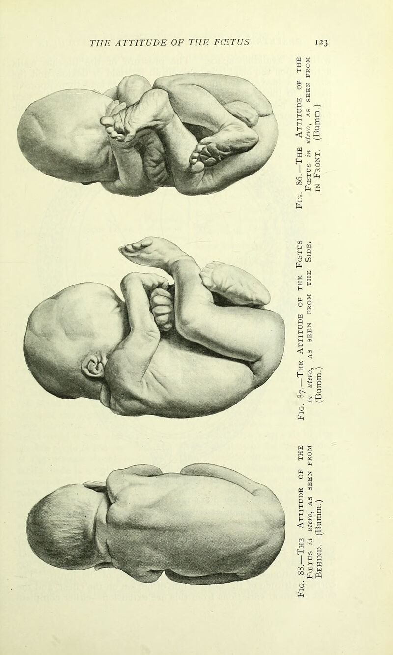 w s ffi o H OZ Fig. 88.—The Attitude of the Fig. 37.—The Attitude of the Fcetus Fig. 86.—The Attitude of Fcetus in utero, as seen from in utero, as seen from the Side. Fcetus in ute.ro, as seen Behind. (Bumm.) (Bumm.) in Front. (Bumm.)