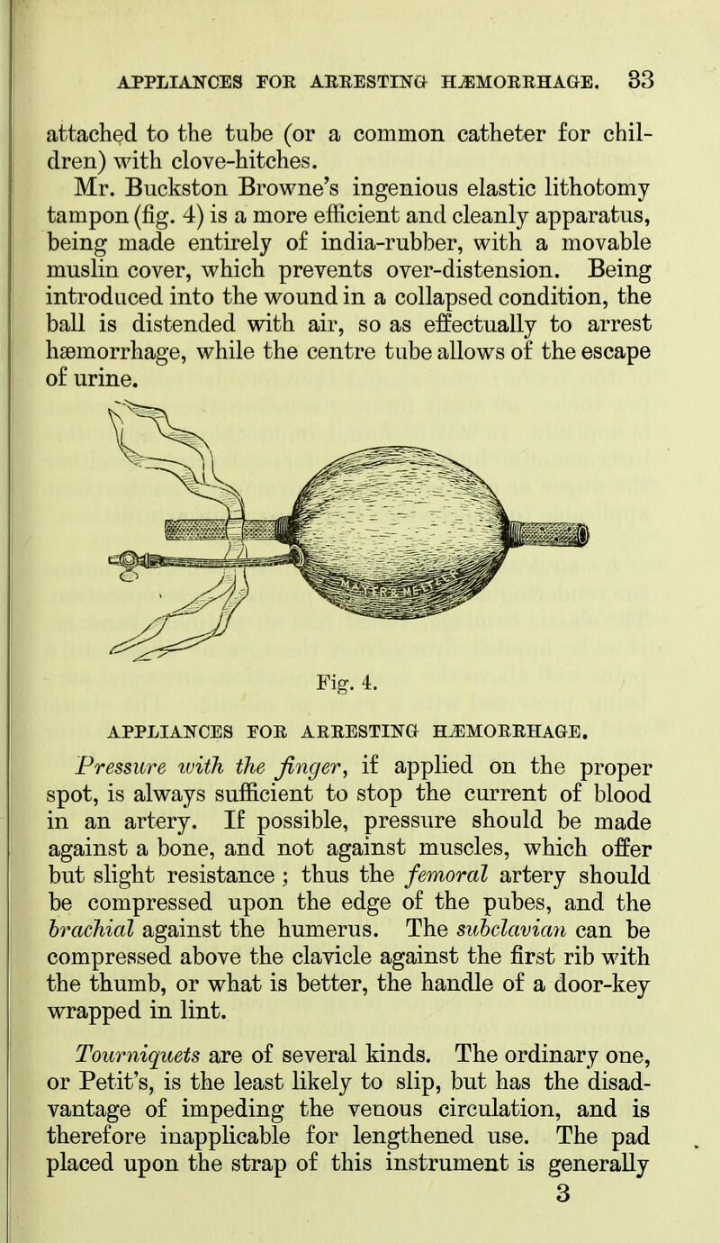 attached to the tube (or a common catheter for chil- dren) with clove-hitches. Mr. Buckston Browne's ingenious elastic lithotomy tampon (fig. 4) is a more efficient and cleanly apparatus, being made entirely of india-rubber, with a movable muslin cover, which prevents over-distension. Being introduced into the wound in a collapsed condition, the ball is distended with air, so as effectually to arrest haemorrhage, while the centre tube allows of the escape of urine. Fig. 4. APPLIANCES FOR ARRESTING HEMORRHAGE. Pressure ivith the finger, if applied on the proper spot, is always sufficient to stop the current of blood in an artery. If possible, pressure should be made against a bone, and not against muscles, which offer but slight resistance; thus the femoral artery should be compressed upon the edge of the pubes, and the brachial against the humerus. The suhdaviaii can be compressed above the clavicle against the first rib with the thumb, or what is better, the handle of a door-key wrapped in lint. Tourniquets are of several kinds. The ordinary one, or Petit's, is the least likely to slip, but has the disad- vantage of impeding the venous circulation, and is therefore inapplicable for lengthened use. The pad placed upon the strap of this instrument is generally 3