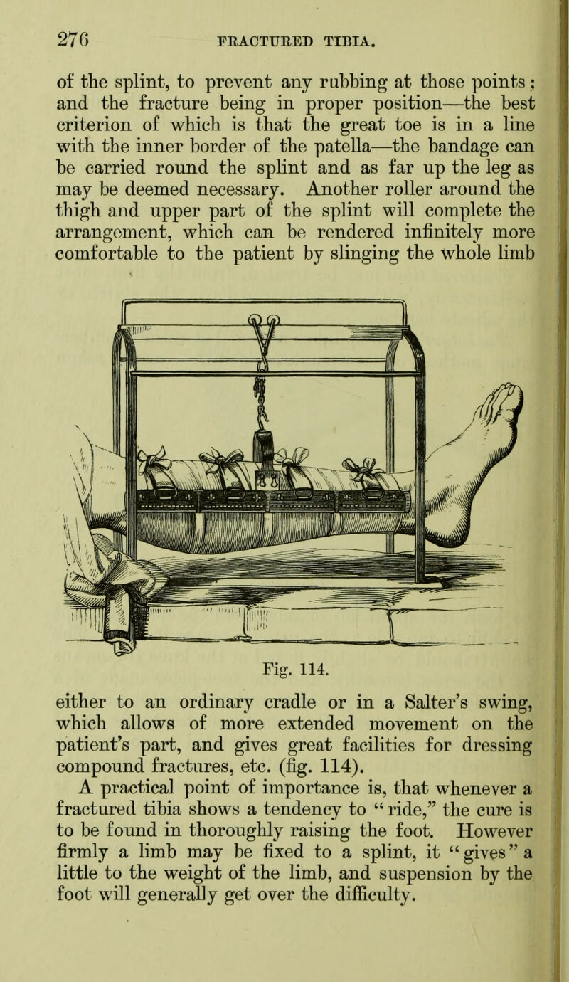 of the splint, to prevent any rubbing at those points; and the fracture being in proper position—the best criterion of which is that the great toe is in a line with the inner border of the patella—the bandage can be carried round the splint and as far up the leg as may be deemed necessary. Another roller around the thigh and upper part of the splint will complete the arrangement, which can be rendered infinitely more comfortable to the patient by slinging the whole limb Fig. 114. either to an ordinary cradle or in a Salter's swing, which allows of more extended movement on the patient's part, and gives great facilities for dressing compound fractures, etc. (fig. 114). A practical point of importance is, that whenever a fractured tibia shows a tendency to  ride, the cure is to be found in thoroughly raising the foot. However firmly a limb may be fixed to a splint, it givesa little to the weight of the limb, and suspension by the foot will generally get over the difficulty.