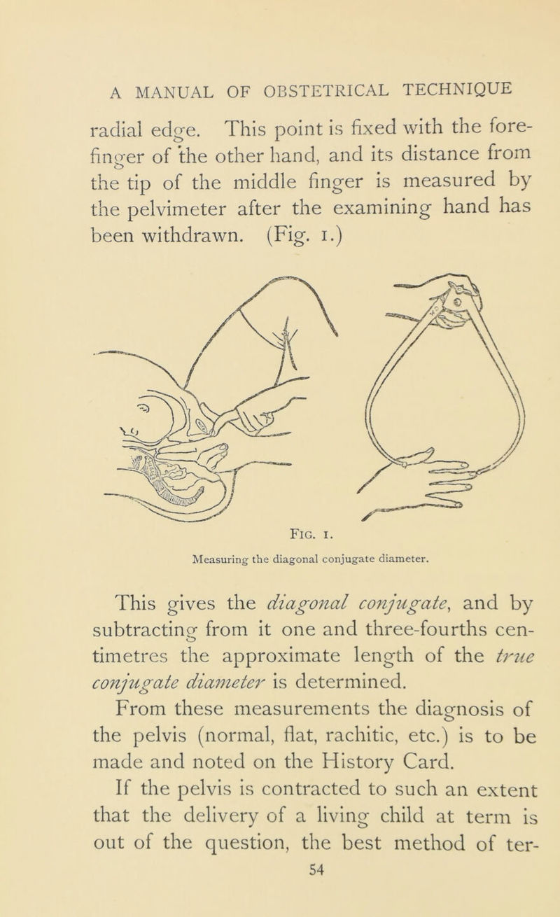 radial edge. This point is fixed with the fore- fin o*er of the other hand, and its distance from o the tip of the middle finger is measured by the pelvimeter after the examining hand has been withdrawn. (Fig. i.) Fig. I. Measuring the diagonal conjugate diameter. This gives the diagonal conjugate, and by subtractine from it one and three-fourths cen- timetres the approximate length of the true conjugate diameter is determined. From these measurements the diagnosis of O the pelvis (normal, flat, rachitic, etc.) is to be made and noted on the History Card. If the pelvis is contracted to such an extent that the delivery of a living child at term is out of the question, the best method of ter-