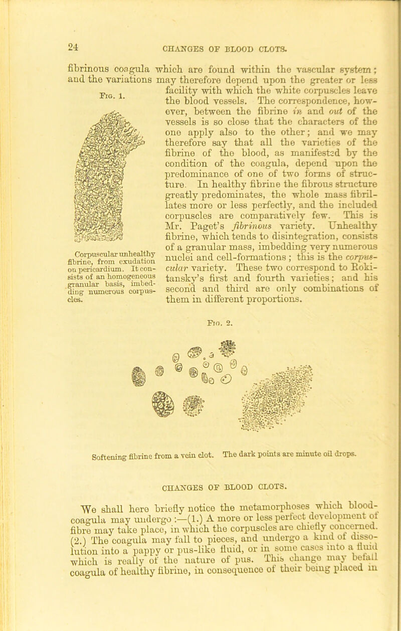 Fig. 1. fibrinous coagula which are found within the vascular system; and the variations may therefore depend upon the greater or less facility with which the white corpuscles leave the blood vessels. The correspondence, how- ever, between the fibrine in and out of the vessels is so close that the characters of the one apply also to the other; and we may therefore say that all the varieties of the fibrine of the blood, as manifested by the condition of the coagula, depend upon the predominance of one of two forms of struc- ture. In healthy fibrine the fibrous structure greatly predominates, the whole mass fibril- lates more or less perfectly, and the included corpuscles are comparatively few. This is Mr. Paget’s fibrinous variety. Unhealthy fibrine, which tends to disintegration, consists of a granular mass, imbedding very numerous nuclei and cell-formations ; this is the corpus- cular variety. These two correspond to Roki- tansky’s first and fourth varieties; and his second and third are only combinations of them in different proportions. ■ifm.SsSS Corpuscular unhealthy fibrine, from exudation on pericardium. It con- gists of an homogeneous granular basis, imbed- ding numerous corpus- cles. Fio. 2. Softening fibrine from a vein dot. The dark points are minute oil drops. CHANGES OF BLOOD CLOTS. We shall here briefly notice the metamorphoses which blood- coagula may undergo :—(1.) A more or less perfect develojmient ol fibre may take place, in which the corpuscles are chiefly concerned. (2.) The coagula may fall to pieces, and undergo a kind ol disso- lution into a pappy or pus-like fluid, or in some cases into a fluid which is really of the nature of pus. This change may befall coagula of healthy fibrine, in consequence of their being placed m