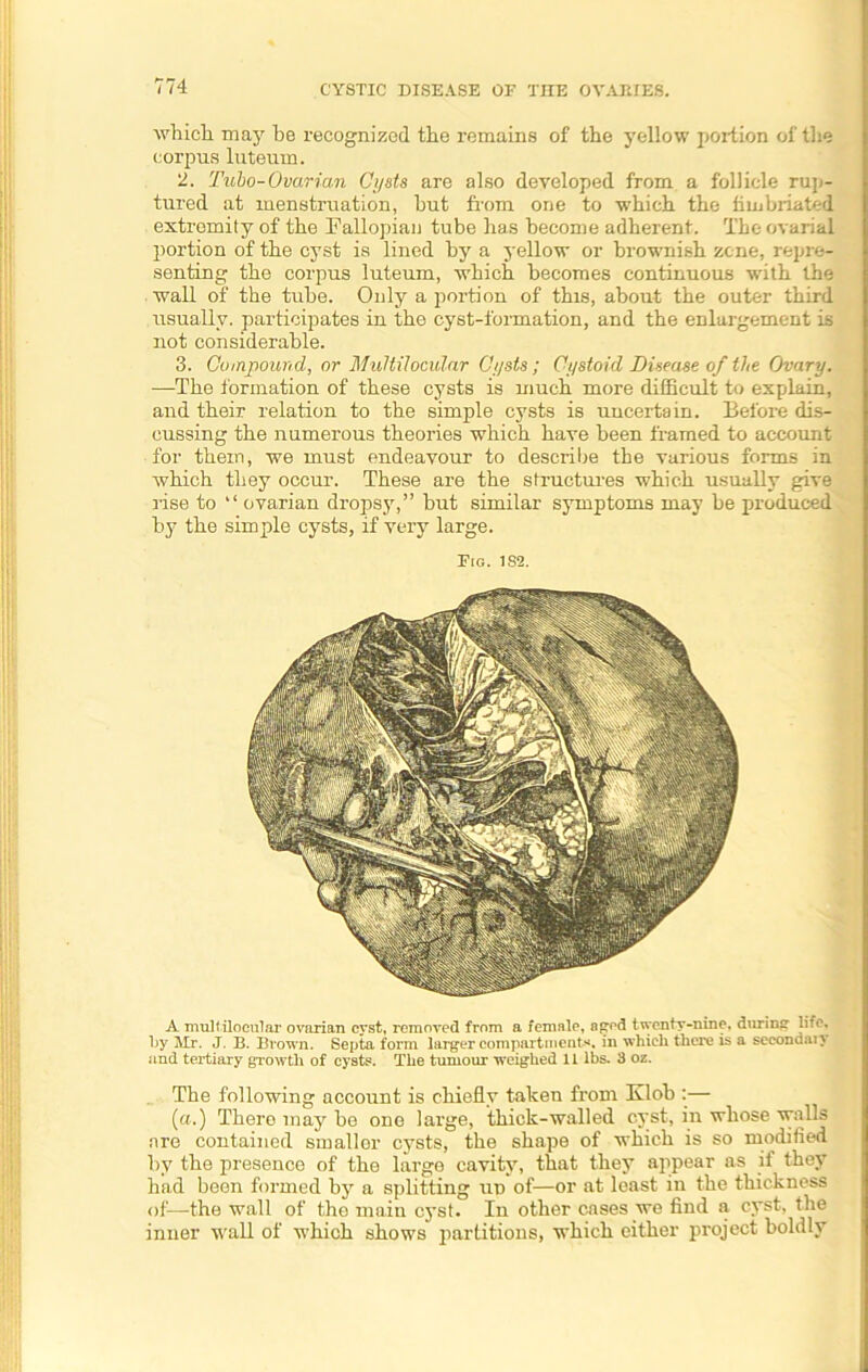 which may he recognized the remains of the yellow portion of the corpus luteurn. 2. Tubo-Ovarian Cysts are also developed from a follicle rup- tured at menstruation, hut from one to which the fimbriated extremity of the Fallopian tube has become adherent. The ovarial portion of the cyst is lined by a yellow or brownish zone, repre- senting the corpus luteurn, which becomes continuous with the wall of the tube. Only a portion of this, about the outer third usually, participates in the cyst-formation, and the enlargement is not considerable. 3. Compound, or Multiloculnr Cysts ; Cystoid Disease of the Ovary. —The formation of these cysts is much more difficult to explain, and their relation to the simple cysts is uncertain. Before dis- cussing the numerous theories which have been framed to account for them, we must endeavour to describe the various forms in which they occur. These are the structures which usually give rise to “ ovarian dropsy,” hut similar symptoms may be produced by the simple cysts, if very large. Fig. 1S2. A mullilocular ovarian cyst, removed from a female, aged twenty-nine, during htc, by Mr. J. B. Brown. Septa form larger compartments, in which tlici'e is a secondan and tertiary growth of cysts. The tumour weighed 11 lbs. 3 oz. The following account is chiefly taken from Klob :— (a.) There may he one large, thick-walled cyst, in whose walls are contained smaller cysts, the shape of which is so modified by the presence of the large cavity, that they appear as if they had been formed by a splitting uo of—or at least in the thickness of—the wall of the main cyst. In other cases we find a cyst, the inner wall of which shows partitions, which either project boldly