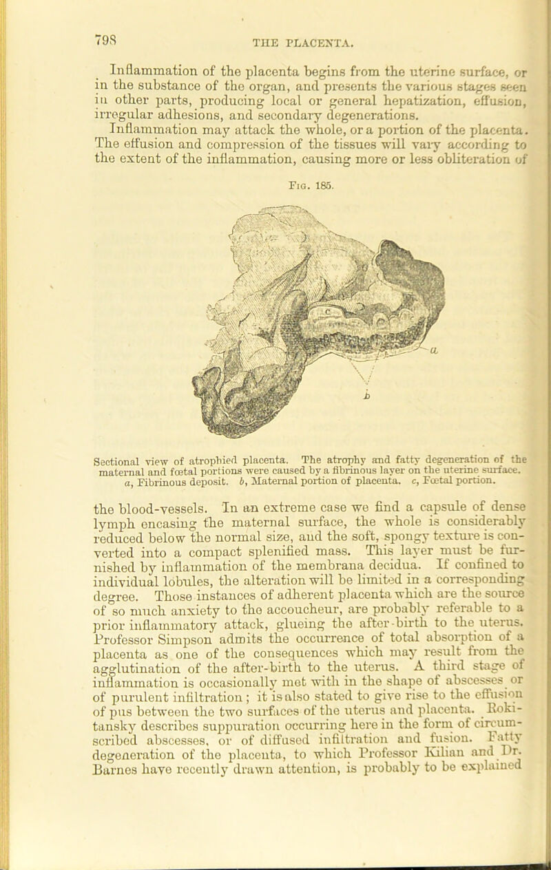 79S Inflammation of the placenta begins from the uterine surface, or in the substance of the organ, and presents the various stages seen in other parts, producing local or general hepatization, effusion, irregular adhesions, and secondary degenerations. Inflammation may attack the whole, ora portion of the placenta. The effusion and compression of the tissues will vaiy according to the extent of the inflammation, causing more or less obliteration of Fig. 185. Sectional view of atrophied placenta. The atrophy and fatty degeneration of the maternal and foetal portions were caused by a fibrinous layer on the uterine surface. a, Fibrinous deposit, b, Maternal portion of placenta, c, Foetal portion. the blood-vessels. In an extreme case we find a capsule of dense lymph encasing the maternal surface, the whole is considerably reduced below the normal size, and the soft, spongy texture is con- verted into a compact splenified mass. This layer must he fur- nished by inflammation of the membrana decidua. If confined to individual lobules, the alteration will be limited in a corresponding degree. Those instances of adherent placenta which are the source of so much anxiety to the accoucheur, are probably referable to a prior inflammatory attack, glueing the after-birth to the uterus. Professor Simpson admits the occurrence of total absorption of a placenta as one of the consequences which may result from the agglutination of the after-birth to the uterus. A third stage oi iutlammation is occasionally met with in the shape of abscesses or of purulent infiltration; it is also stated to give rise to the effusion of pus between the two surfaces of the uterus and placenta. _ Roki- tansky describes suppuration occurring herein the form of circum- scribed abscesses, or of diffused infiltration and fusion. Fatty degeneration of the placenta, to which Professor Ivilian and Dr. Earnes have recently drawn attention, is probably to be explained