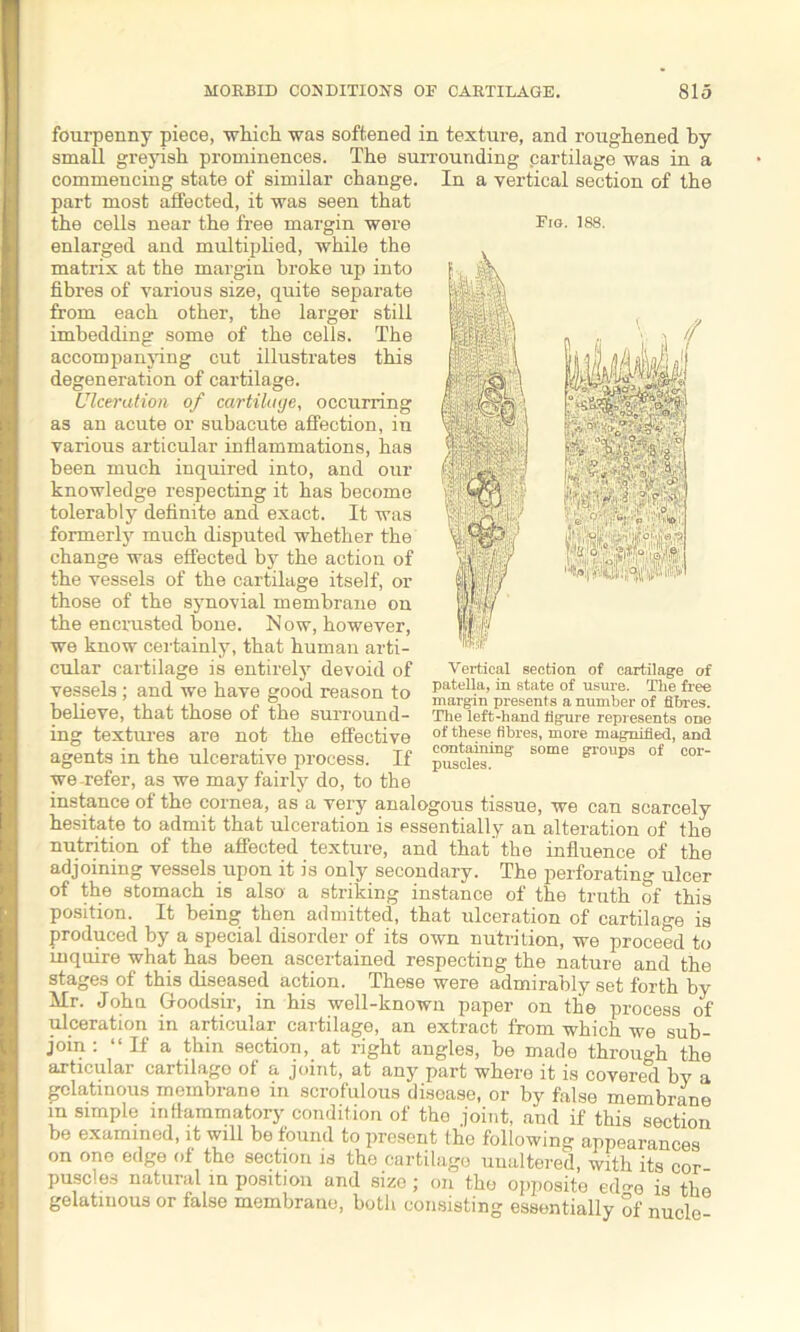 fourpenny piece, which was softened in texture, and roughened by small greyish prominences. The surrounding cartilage was in a commencing state of similar change. In a vertical section of the part most affected, it was seen that the cells near the free margin wei’e Fig. 188. enlarged and multiplied, while the matrix at the margin broke up into fibres of various size, quite separate from each other, the larger still imbedding some of the cells. The accompanying cut illustrates this degeneration of cartilage. Ulceration of cartilage, occurring as an acute or subacute affection, in various articular inflammations, has been much inquired into, and our knowledge respecting it has become tolerably definite and exact. It was formerly much disputed whether the change was effected by the action of the vessels of the cartilage itself, or those of the synovial membrane on the encrusted bone. Now, however, we know certainly, that human arti- cular cartilage is entirely devoid of vessels; and we have good reason to patella’in state of ueure. The free believe, txiat tnose OI toe surround- The left-hand figure represents one ing textures are not the effective of the.se. fibres, more magnified, and agents in the ulcerative process. If p™cies™S S°me sroups of cor we-refer, as we may fairly do, to the instance of the cornea, as a very analogous tissue, we can scarcely hesitate to admit that ulceration is essentially an alteration of the nutrition of the affected texture, and that the influence of the adjoining vessels upon it is only secondary. The perforating ulcer of the stomach is also a striking instance of the truth of this position. It being then admitted, that ulceration of cartilage is produced by a special disorder of its own nutrition, we proceed to inquire what has been ascertained respecting the nature and the stages of this diseased action. These were admirably set forth by Mr. Johu Goodsir, in his well-known paper on the process of ulceration in articular cartilage, an extract from which we sub- join : “If a thin section, at right angles, be made through the articular cartilage of a joint, at any part where it is covered by a gelatinous membrane in scrofulous disease, or by false membrane m simple inflammatory condition of the joint, and if this section be examined, it will be found to present the following appearances on ono edge of the section is the cartilage unaltered, with its cor puscles natural in position and size ; on the opposite ede is the gelatinous or false membrane, both consisting essentially of nucle Vertical section of cartilage of