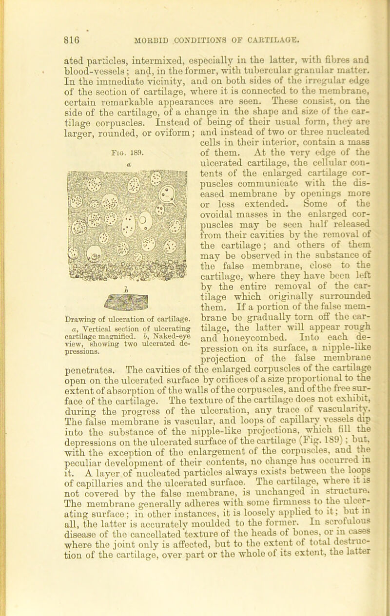 ated particles, intermixed, especially in the latter, with fibres and blood-vessels; and, in the former, with tubercular granular matter. In the immediate vicinity, and on both sides of the irregular edge of the section of cartilage, where it is connected to the membrane, certain remarkable appearances are seen. These consist, on the side of the cartilage, of a change in the shape and size of the car- tilage corpuscles. Instead of being of their usual form, they are larger, rounded, or oviform; and instead of two or three nucleated cells in their interior, contain a mass of them. At the very edge of the ulcerated cartilage, the cellular con- tents of the enlarged cartilage cor- puscles communicate with the dis- eased membrane by openings more or less extended. Some of the ovoidal masses in the enlarged cor- puscles may be seen half released from their cavities by the removal of the cartilage; and others of them may be observed in the substance of the false membrane, close to the cartilage, where they have been left by the entire removal of the car- tilage which originally surrounded them. If a portion of the false mem- brane be gradually torn off the car- tilage, the latter will appear rough and honeycombed. Into each de- pression on its surface, a nipple-like projection of the false membrane penetrates. The cavities of the enlarged corpuscles of the cartilage open on the ulcerated surface by orifices of a size proportional to the extent of absorption of the walls of the corpuscles, and of the free sur- face of the cartilage. The texture of the cartilage does not exhibit, during the progress of the ulceration, any trace of vascularity. The false membrane is vascular, and loops of capillary vessels dip into the substance of the nipple-like projections, which fill the depressions on the ulcerated surface of the cartilage (Fig. 1S9): but. with the exception of the enlargement of the corpuscles, aud the peculiar development of their contents, no change has occurred in it. A layer of nucleated particles always exists between the loops of capillaries and the ulcerated surface. The cartilage, where it is not covered by the false membrane, is unchanged in structure. The membrane generally adheres with some firmness to the ulcer- ating surface; in other instances, it is loosely applied to it; but in all, the latter is accurately moulded to the former. In scrofulous disease of the cancellated texture of the heads of bones, or in cases where the joint only is affected, but to the extent of total destruc- tion of the cartilage, over part or the whole of its extent, the latter Fig. 189. Drawing of ulceration of cartilage. a, Vertical section of ulcerating cartilage magnified, b. Naked-eye view, showing two ulcerated de- pressions.