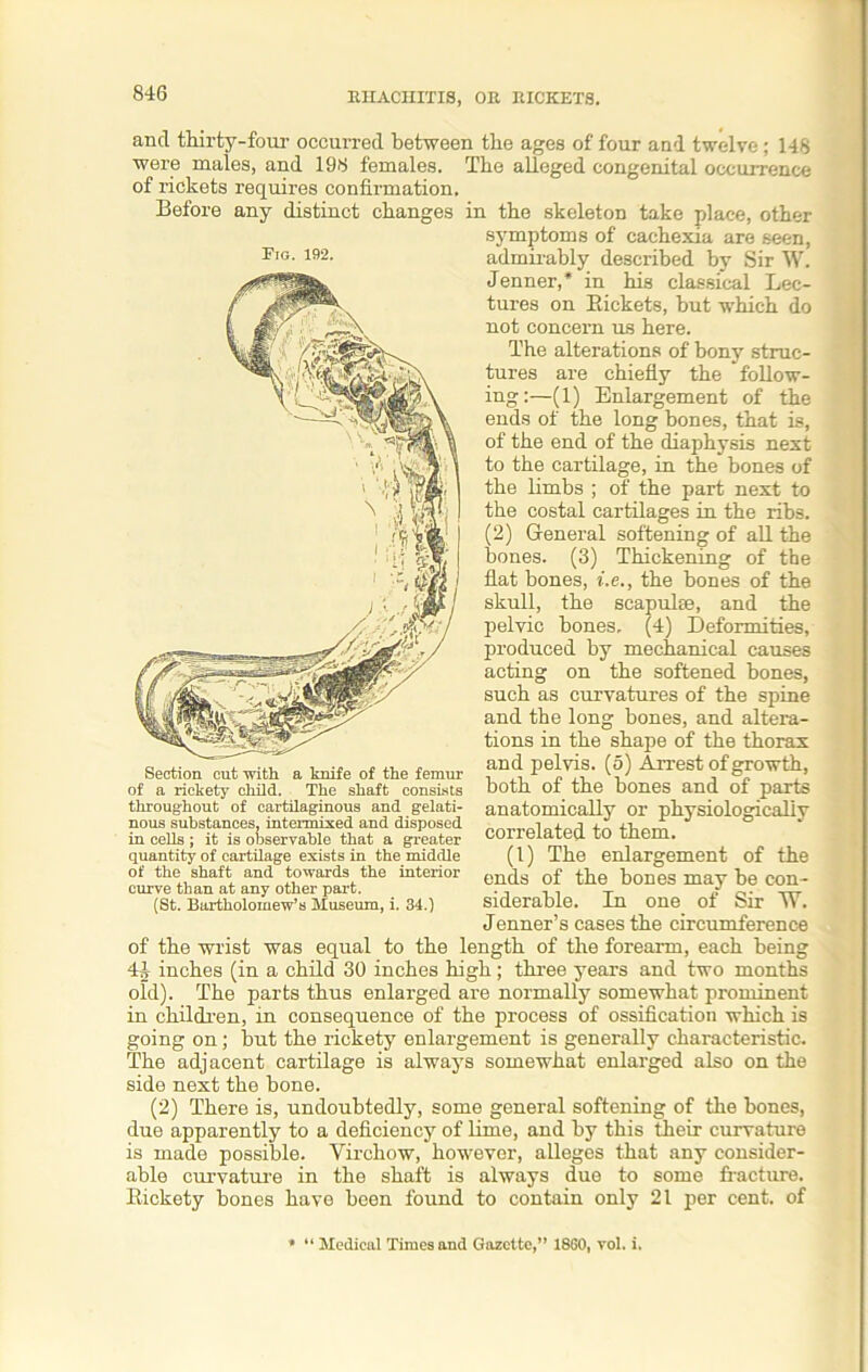 and thirty-four occurred between the ages of four and twelve; 148 were males, and 198 females. The alleged congenital occurrence of rickets requires confirmation. Before any distinct changes in the skeleton take place, other symptoms of cachexia are seen, admirably described by Sir W. Jenner,* in his classical Lec- tures on Rickets, but which do not concern us here. The alterations of bony struc- tures are chiefly the follow- ing:—(1) Enlargement of the ends of the long bones, that is, of the end of the diaphysis next to the cartilage, in the bones of the limbs ; of the part next to the costal cartilages in the ribs. (2) General softening of all the bones. (3) Thickening of the flat bones, i.e., the bones of the skull, the scapulte, and the pelvic bones, (4) Deformities, produced by mechanical causes acting on the softened bones, such as curvatures of the spine and the long bones, and altera- tions in the shape of the thorax and pelvis. (5) Arrest of growth, both of the bones and of parts anatomically or physiologically correlated to them. (1) The enlargement of the ends of the bones may be con- siderable. In one of Sir ~W. Jenner’s cases the circumference of the wrist was equal to the length of the forearm, each being 41 inches (in a child 30 inches high; three years and two months old). The parts thus enlarged are normally somewhat prominent in children, in consequence of the process of ossification which is going on; but the rickety enlargement is generally characteristic. The adjacent cartilage is always somewhat enlarged also on the side next the bone. (2) There is, undoubtedly, some general softening of the bones, due apparently to a deficiency of lime, and by this their curvature is made possible. Virchow, however, alleges that any consider- able curvature in the shaft is always due to some fracture. Rickety bones have been found to contain only 21 per cent, of • “ Medical Times and Gazette,” 1860, vol. i. Pig. 192. Section cut with a knife of the femur of a rickety child. The shaft consists throughout of cartilaginous and gelati- nous substances, intermixed and disposed in cells ; it is observable that a greater quantity of cartilage exists in the middle of the shaft and towards the interior curve than at any other part. (St. Bartholomew’s Museum, i. 34.)