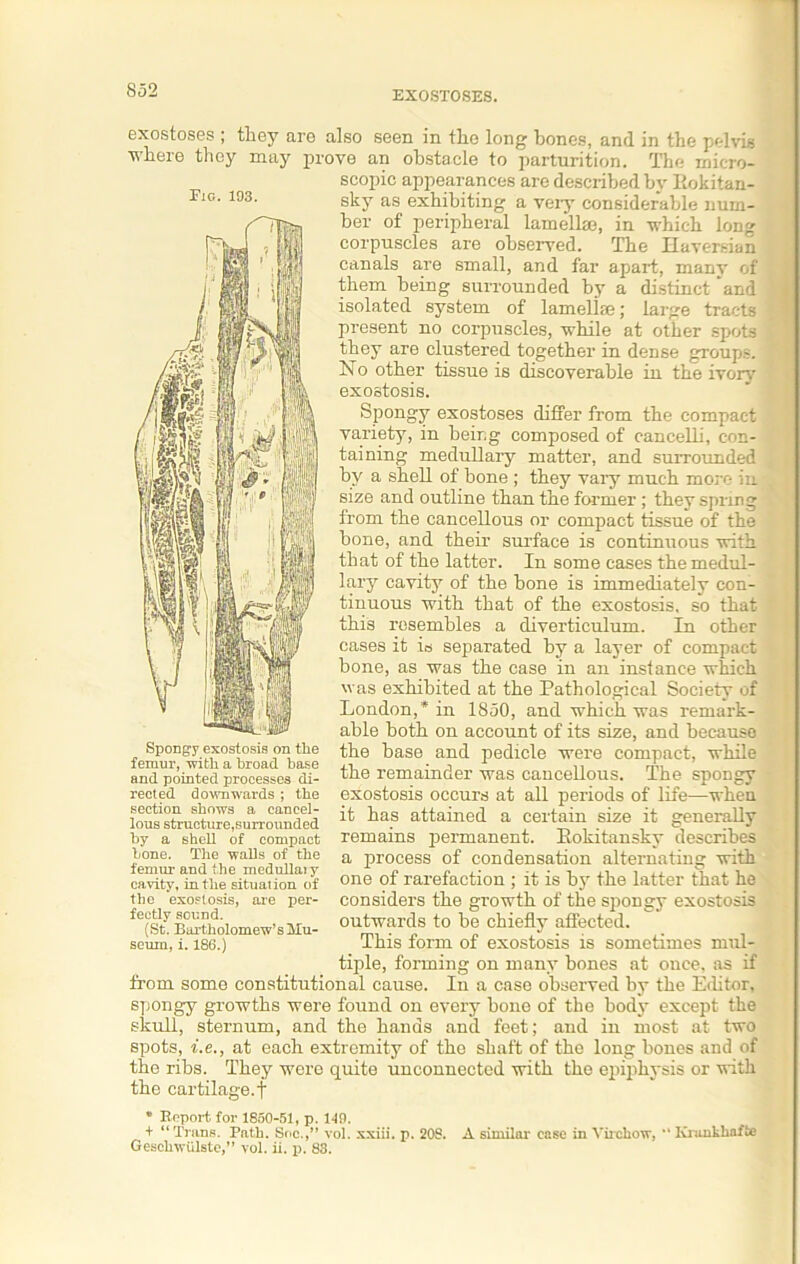 EXOSTOSES. Fig. 193. exostoses ; they aro also seen in the long bones, and in the pelvis where they may prove an obstacle to parturition. The micro- scopic appearances are described by Rokitan- sky as exhibiting a very considerable num- ber of peripheral lamelhe, in which long corpuscles are observed. The Haversian canals are small, and far apart, many of them being surrounded by a distinct and isolated system of lamellse; large tracts present no corpuscles, while at other spots they are clustered together in dense groups. No other tissue is discoverable in the ivory exostosis. Spongy exostoses differ from the compact variety, in being composed of cancelli, con- taining medullary matter, and surrounded by a shell of bone ; they vaiy much more in size and outline than the former ; they spring from the cancellous or compact tissue of the bone, and their surface is continuous with that of the latter. In some cases themedul- lary cavity of the bone is immediately con- tinuous with that of the exostosis, so that this resembles a diverticulum. In other cases it is separated by a layer of compact bone, as was the case in an instance which was exhibited at the Pathological Society of London,* in 1850, and which was remark- able both on account of its size, and because the base and pedicle were compact, while the remainder was cancellous. The spongy exostosis occurs at all periods of life—when it has attained a certain size it generally remains permanent. Rokitansky describes a process of condensation alternating with one of rarefaction ; it is by the latter that he considers the growth of the spongy exostosis outwards to be chiefly affected. This form of exostosis is sometimes mul- tiple, forming on many bones at once, as if from some constitutional cause. In a case observed by the Editor, spongy growths were found on every bone of the body except the skull, sternum, and the hands and feet; and in most at two spots, i.e., at each extremity of tho shaft of the long bones and of the ribs. They were quite unconnected with the epiphysis or with the cartilage.t Spongy exostosis on the femur, -with a broad base and pointed processes di- rected downwards ; the section shows a cancel- lous structure, surrounded by a shell of compact bone. The walls of the femur and the medullai y cavity, in the situation of the exostosis, are per- fectly sound. (St. Bartholomew’s Mu- seum, i. 186.) * Report for 1850-51, p. 140. + “Trans. Path. Soc.,” vol. xxiii. p. 208. A similar ease in Virchow, “ Krankhaffce Geschwulste,” vol. ii. p. 83.