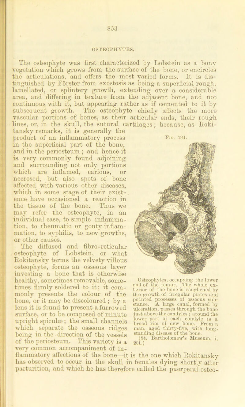 8.33 OSTEOPHYTES. The osteophyte was first characterized by Lobstein as a bony vegetation which grows from the surface of the bone, or encircles the articulations, and offers the most varied forms. It is dis- tinguished by Forster from exostosis as being a superficial rough, lamellated, or splintery growth, extending over a considerable area, and differing in texture from the adjacent bone, and not continuous with it, but appearing rather as if cemented to it by subsequent growth. The osteophyte chiefly affects the more vascular portions of bones, as their articular ends, their rough lines, or, in the skull, the sutural cartilages; because, as Roki- tansky remarks, it is generally the product of an inflammatory process in the superficial part of the bone, and in the periosteum ; and hence it is very commonly found adjoining and surrounding not only portions which are inflamed, carious, or necrosed, but also spots of bone affected with various other diseases, which in some stage of their exist- ence have occasioned a reaction in the tissue of the bone. Thus we may refer the osteophyte, in an individual case, to simple inflamma- tion, to rheumatic or gouty inflam- mation, to syphilis, to new growths, or other causes. The diffused and fibro-reticular osteophyte of Lobstein, or what Rokitansky terms the velvety villous osteophyte, forms an osseous layer investing a bone that is otherwise healthy, sometimes removable, some- times firmly soldered to it; it com- monly presents the colour of the bone, or it may be discoloured ; by a lens it is found to present a furrowed surface, or to be composed of minute upright spicuho ; the small channels which separate the osseous ridges being in the direction of the vessels of the periosteum. This variety is a very common accompaniment of in- flammatory affections of the bone—it is the one which Rokitansky has observed to occur in the skull in females dying shortly after parturition, and which he has therefore called the puerperal osteo- Fig. 191. Osteophytes, occupying the lower end of the femur. The whole ex- terior of the bone is roughened by the growth of irregular plates and pointed processes of osseous sub- stance. A large canal, formed by ulceration, passes through the bone just above the condyles ; around the lower part of each condyle is a broad rim of new bone. From a man, aged thirty-five, with long- standing disease of the bone. (St. Bartholomew’s Museum, i. 201.)